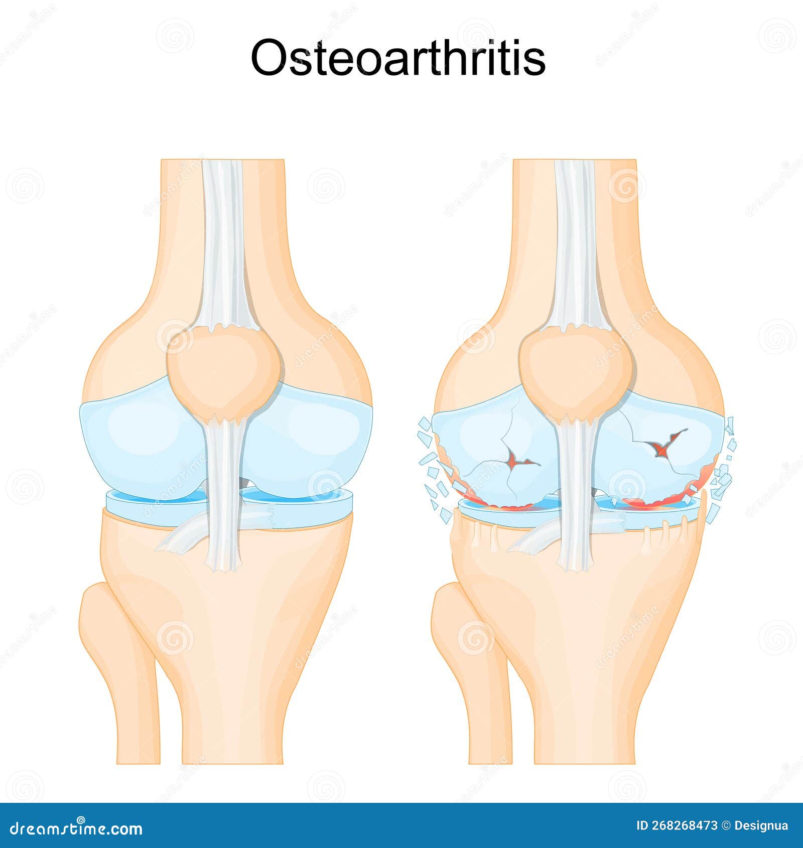 knee osteoarthritis. degenerative joint disease