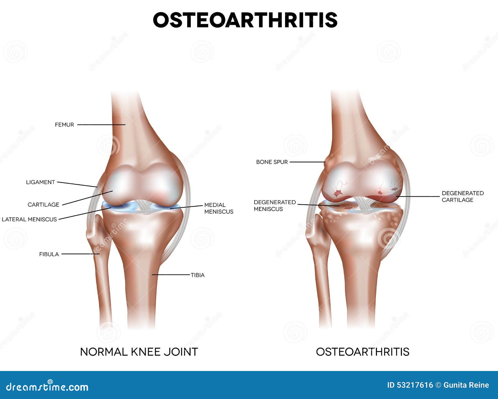 Knee Osteoarthritis stock vector. Illustration of inflammation 53217616