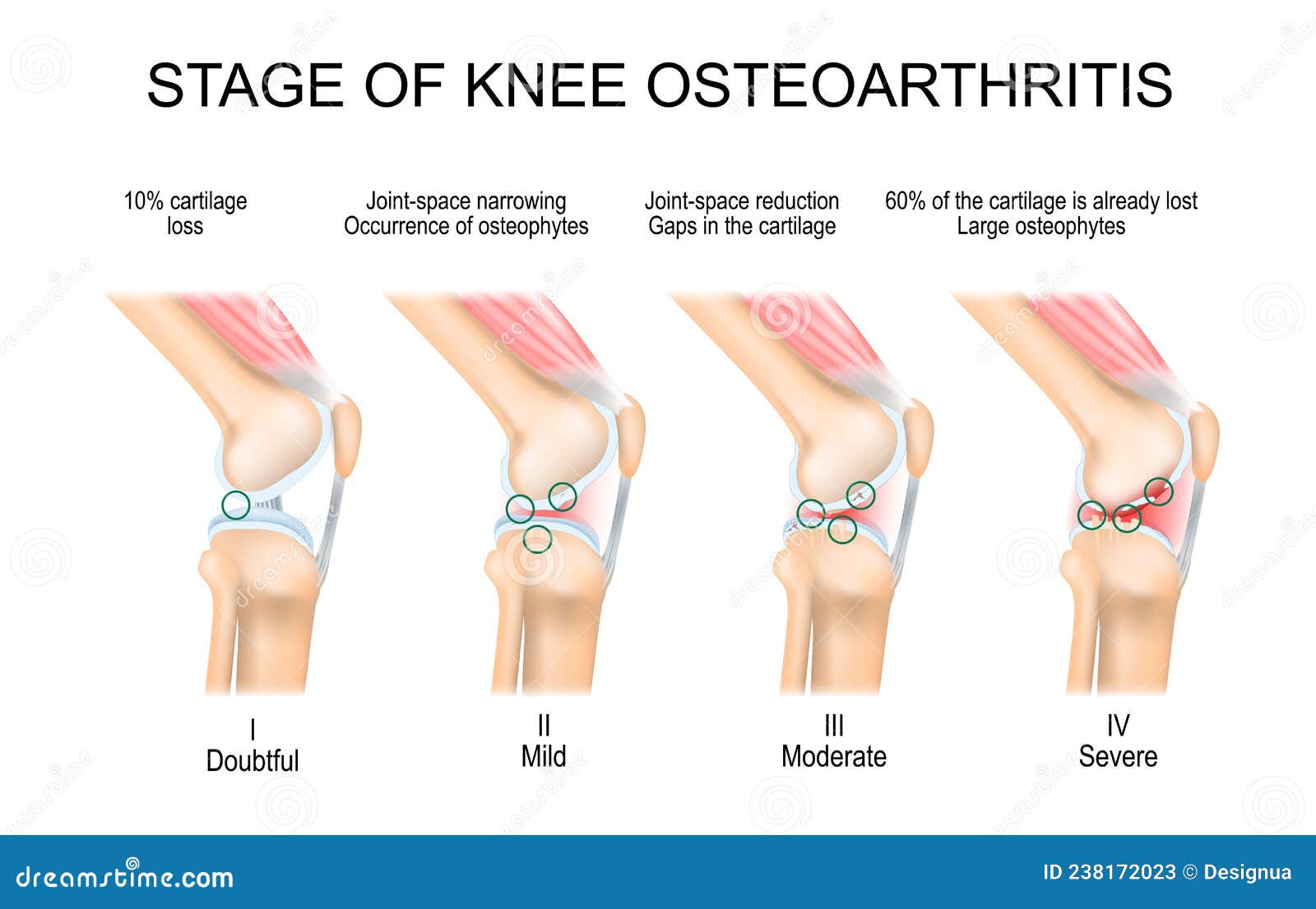 osteoarthritis knee kellgren lawrence