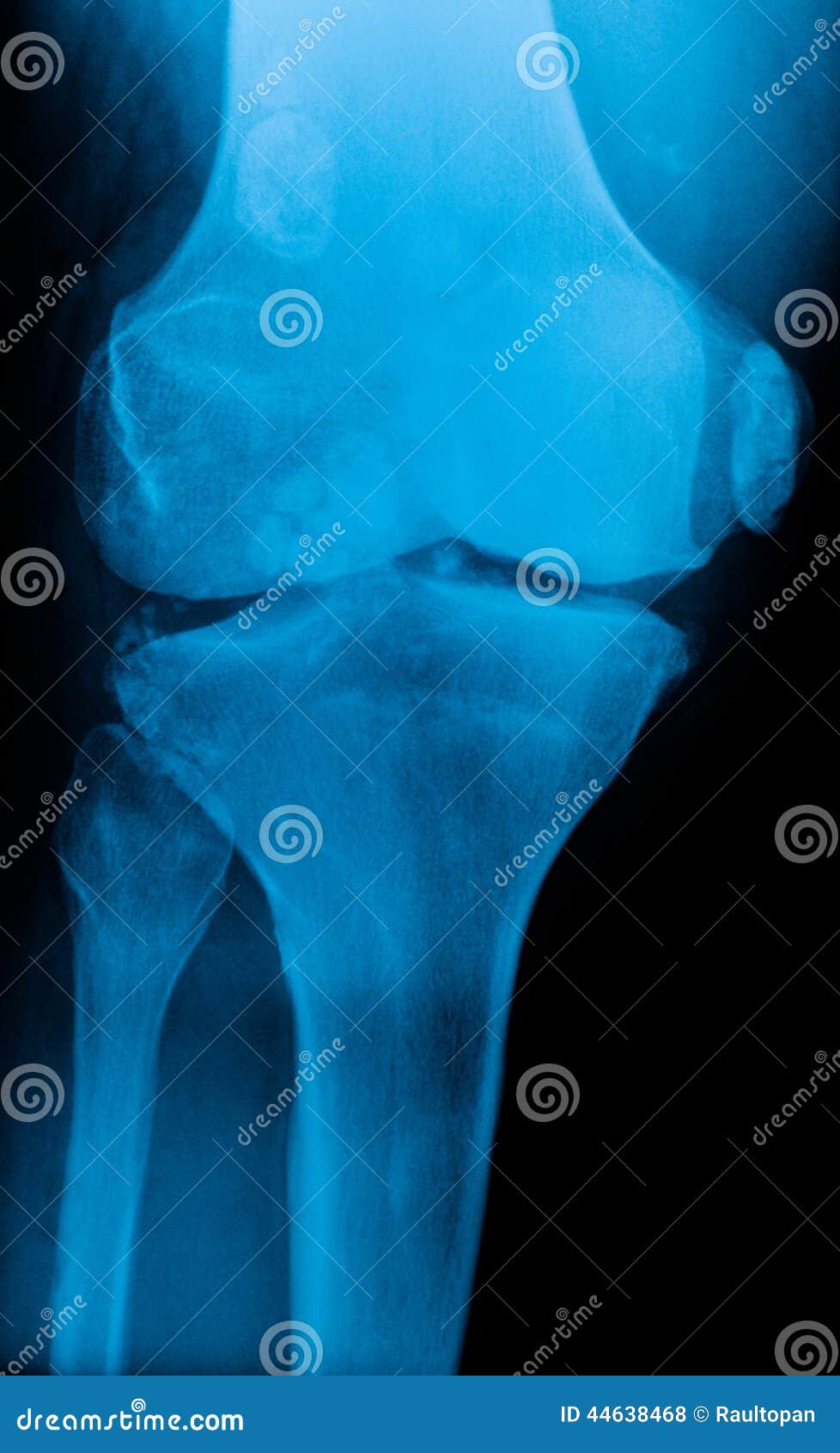Knee xray stock photo. Image of carcass, elderly, cartilage 44638468