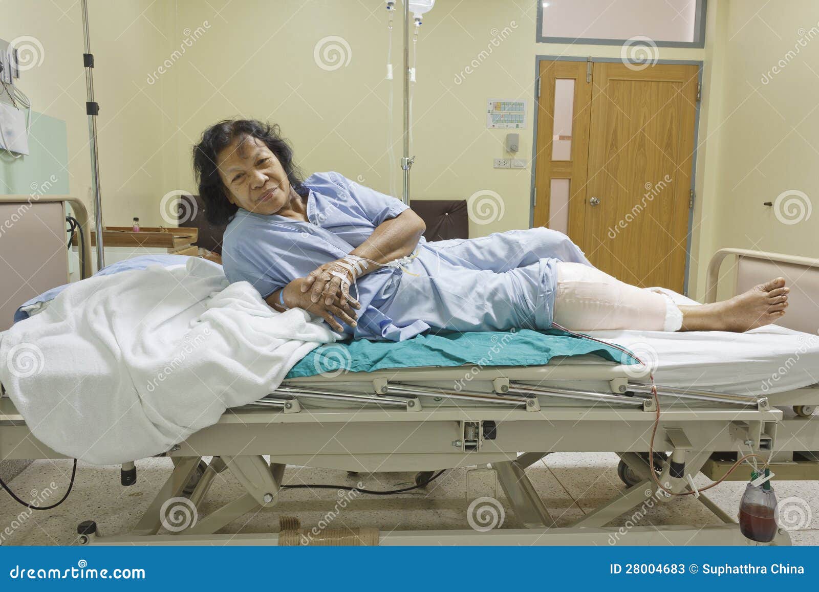 Knee replacement incision stock image. Image of stitch