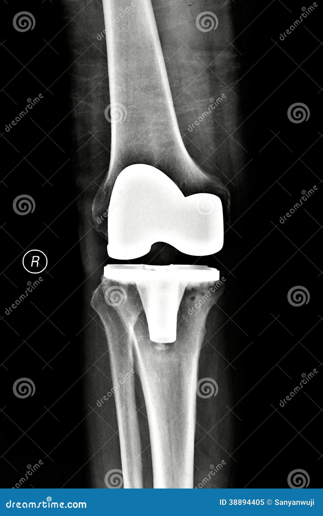 Knee Replacement Xray Pictures Stock Image Image of pharmacology