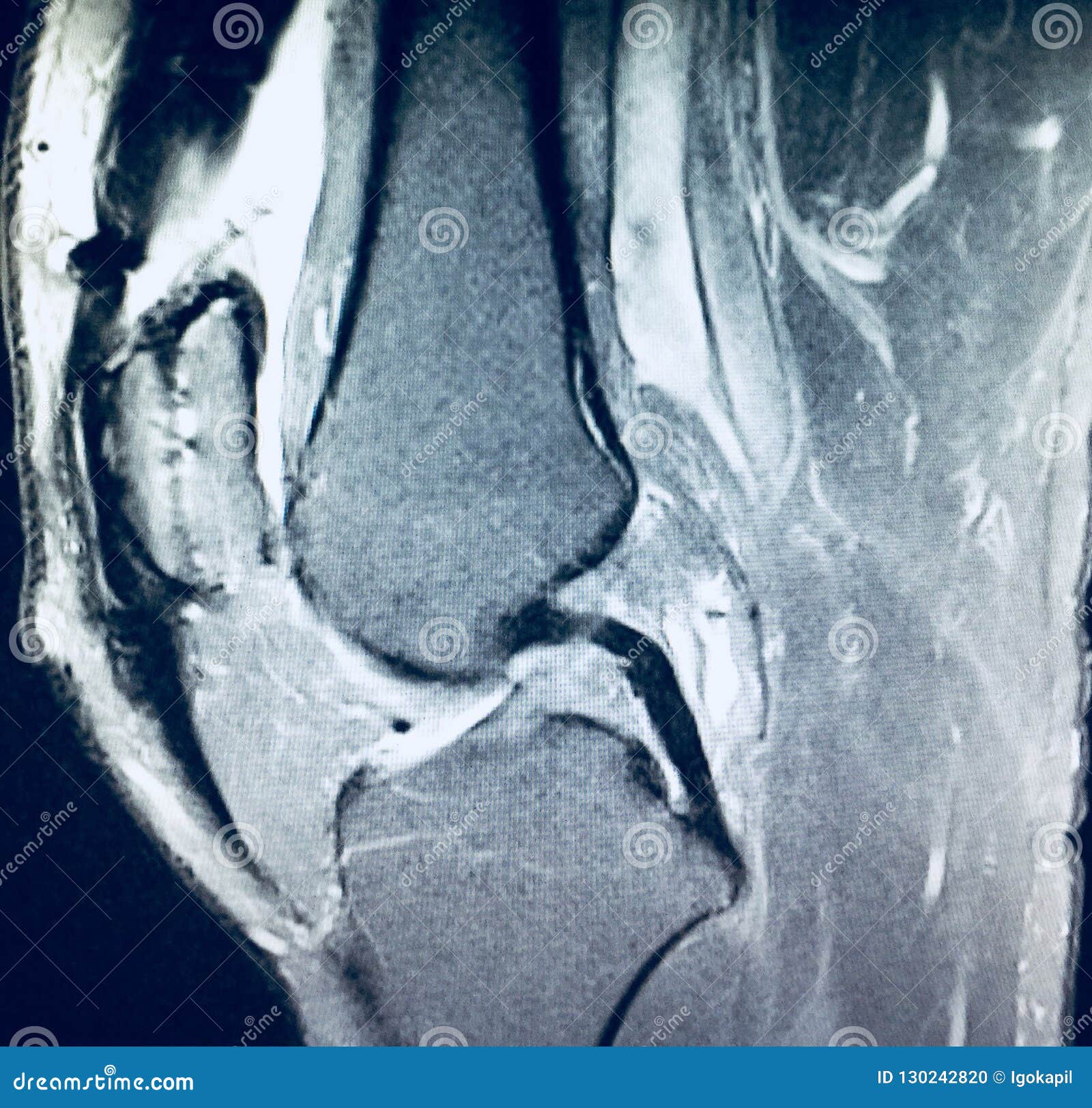 Knee Severe Osteoarthrosis Meniscus Pathology Mri Stock Photo - Image ...