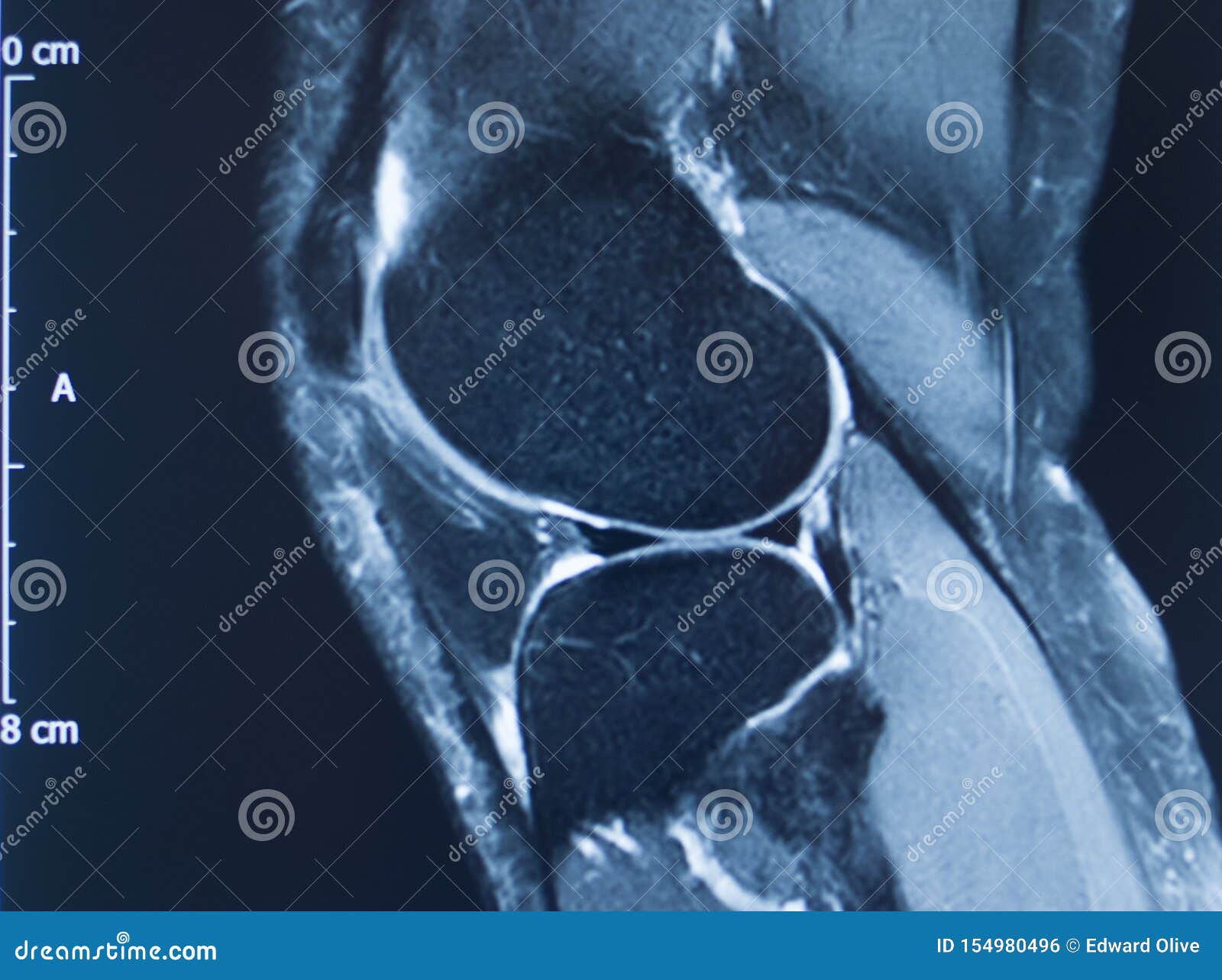 Knee injury mri mcl tear stock photo. Image of human - 154980496