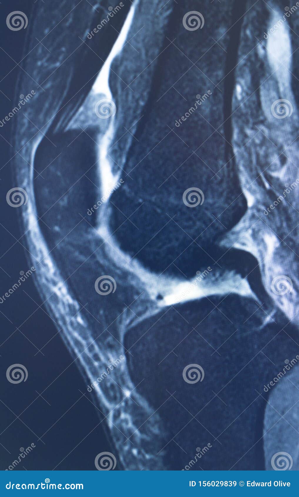 Knee injury mri mcl tear stock image. Image of grade - 156029839