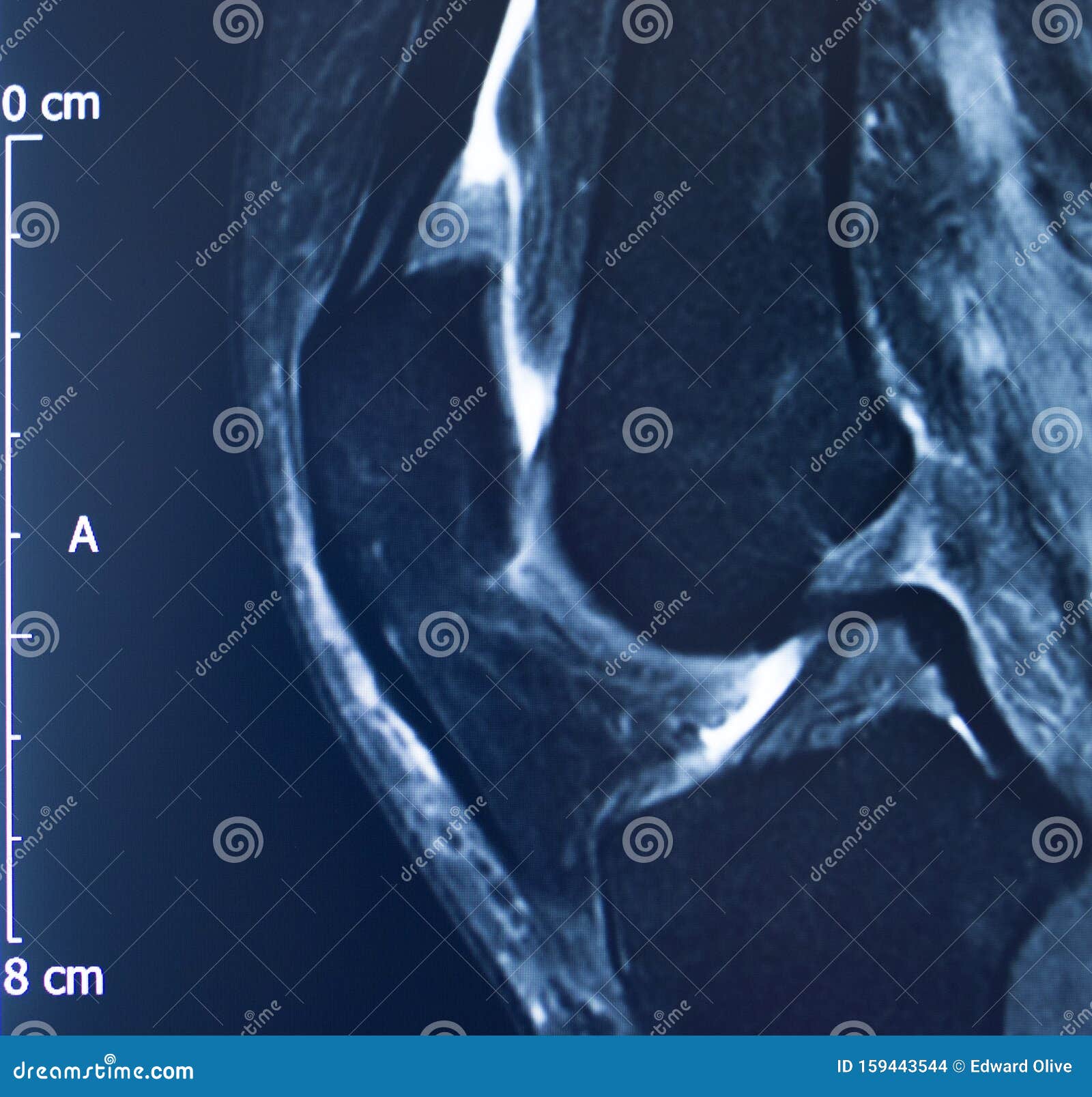 Knee injury mri mcl tear stock photo. Image of anatomy - 159443544