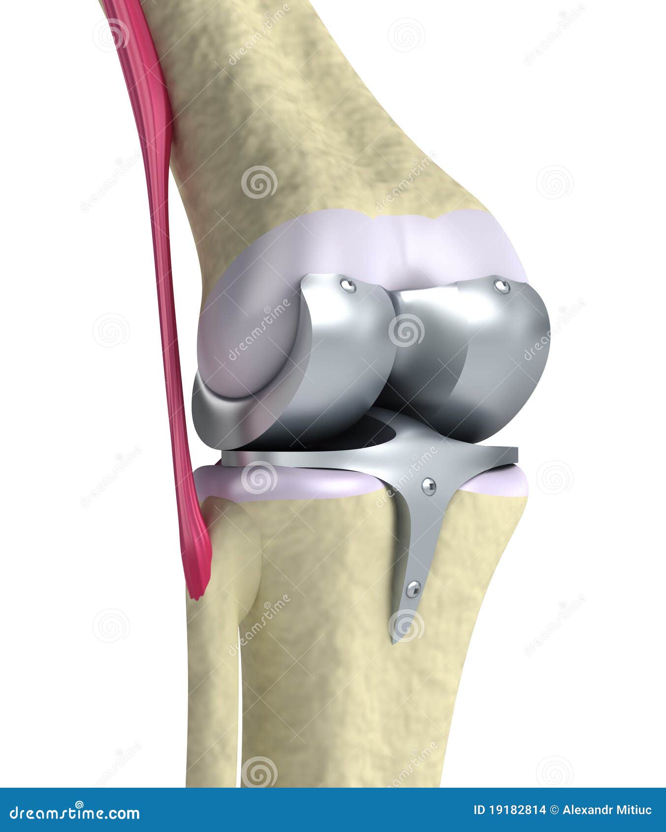 knee and titanium hinge joint