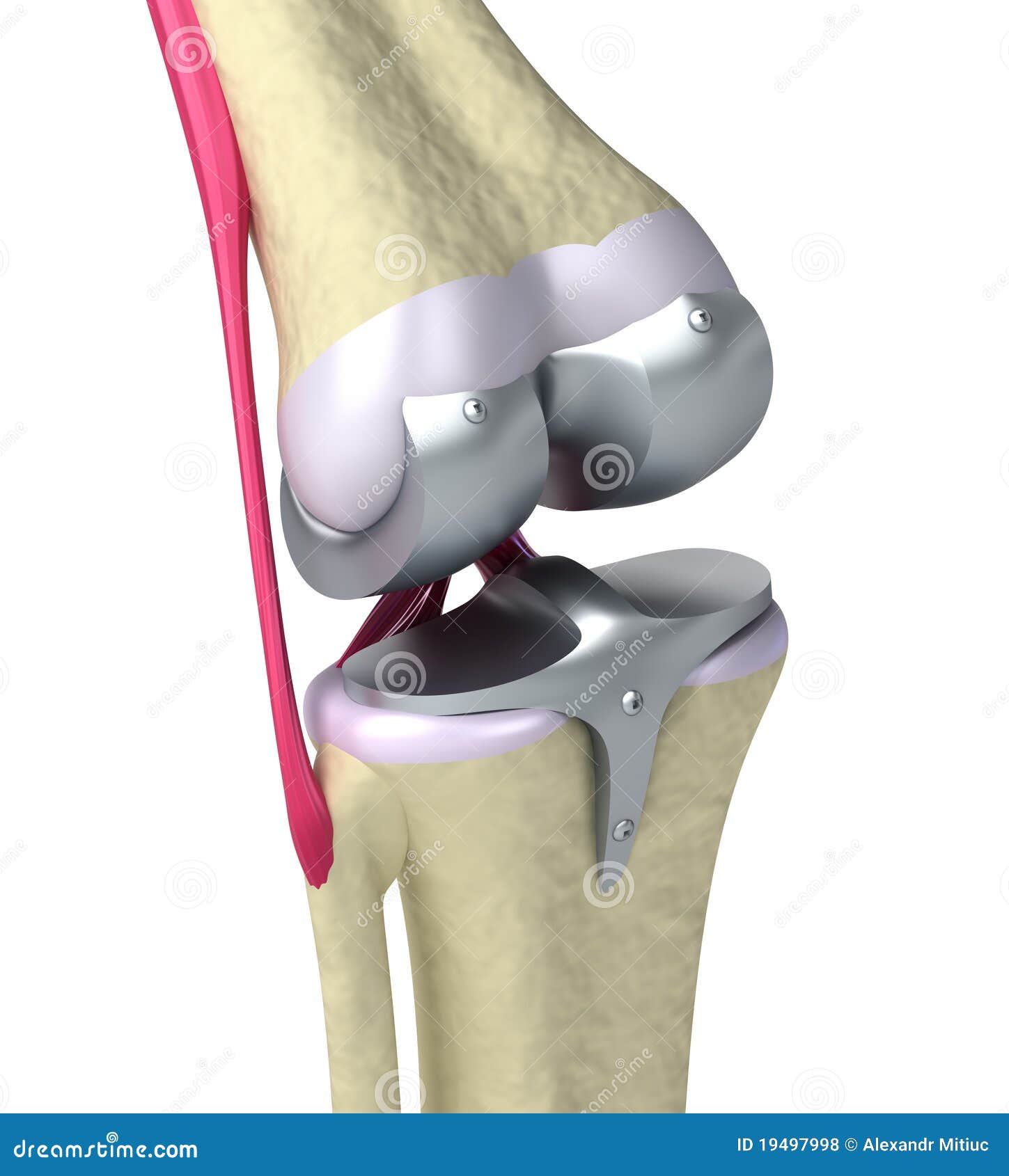 knee and titanium hinge joint