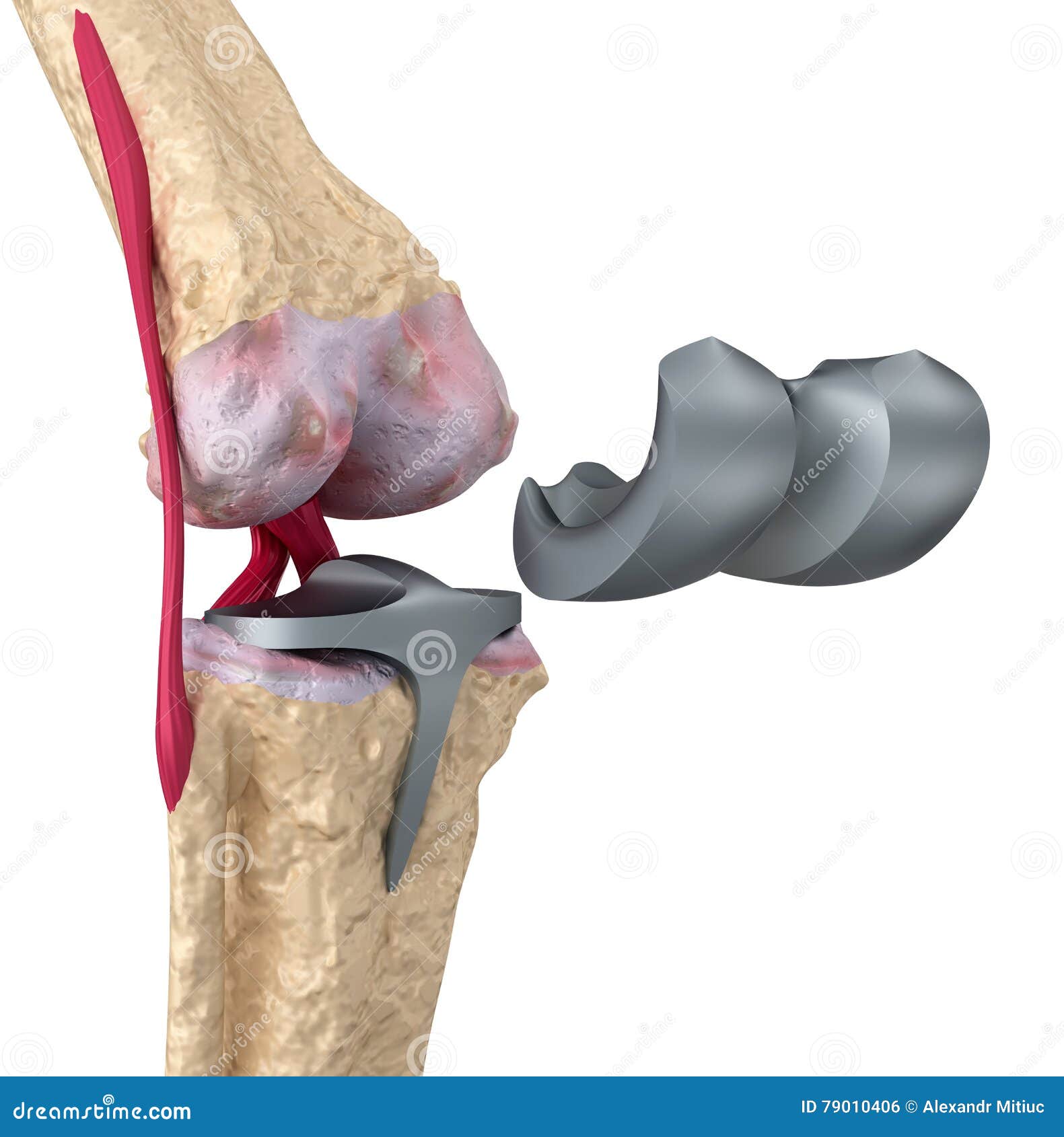 Knee and Titanium Hinge Joint. Isolated Stock Illustration