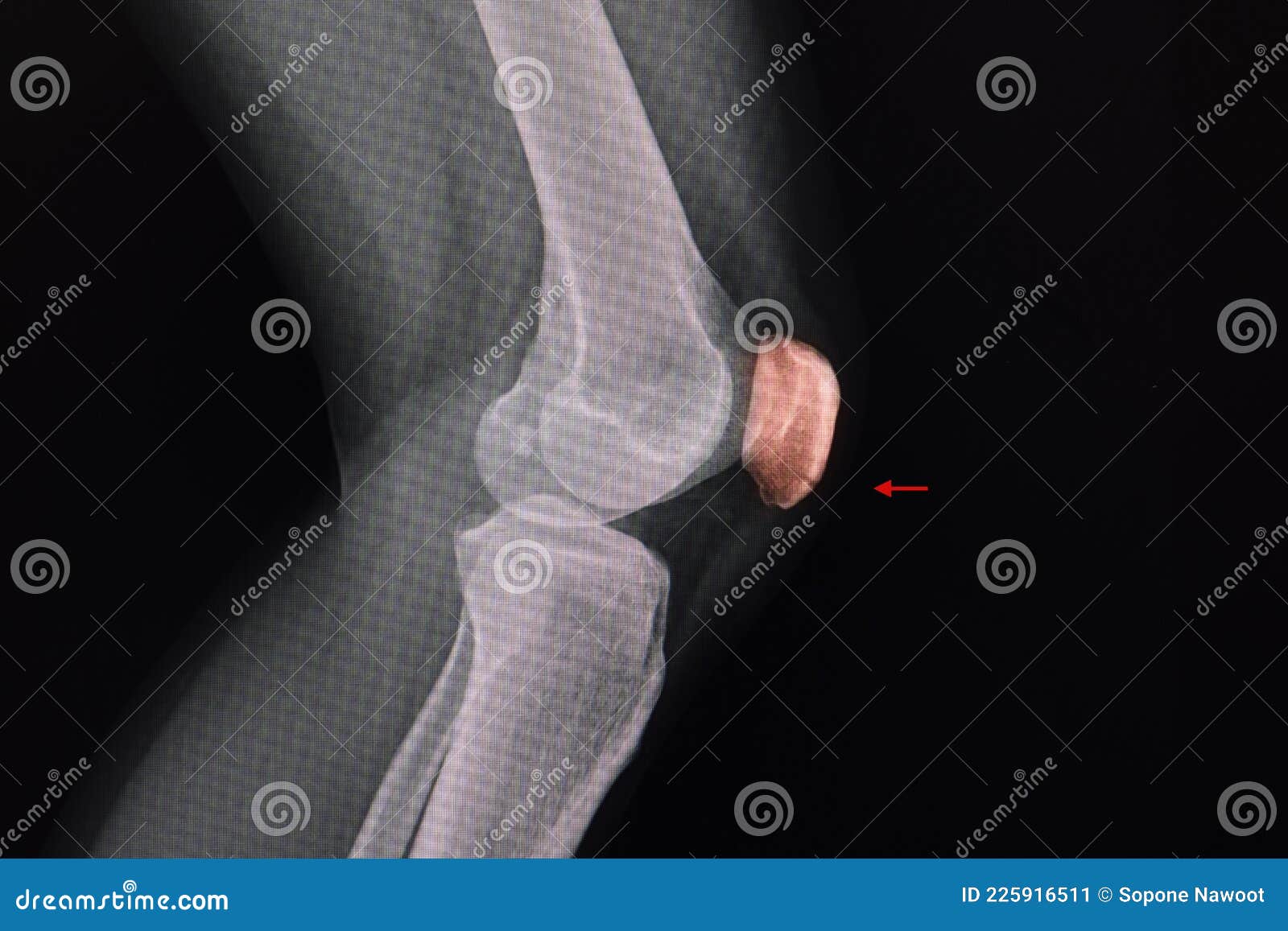 knee xray of a patient showing a lucent line at lower part of patella