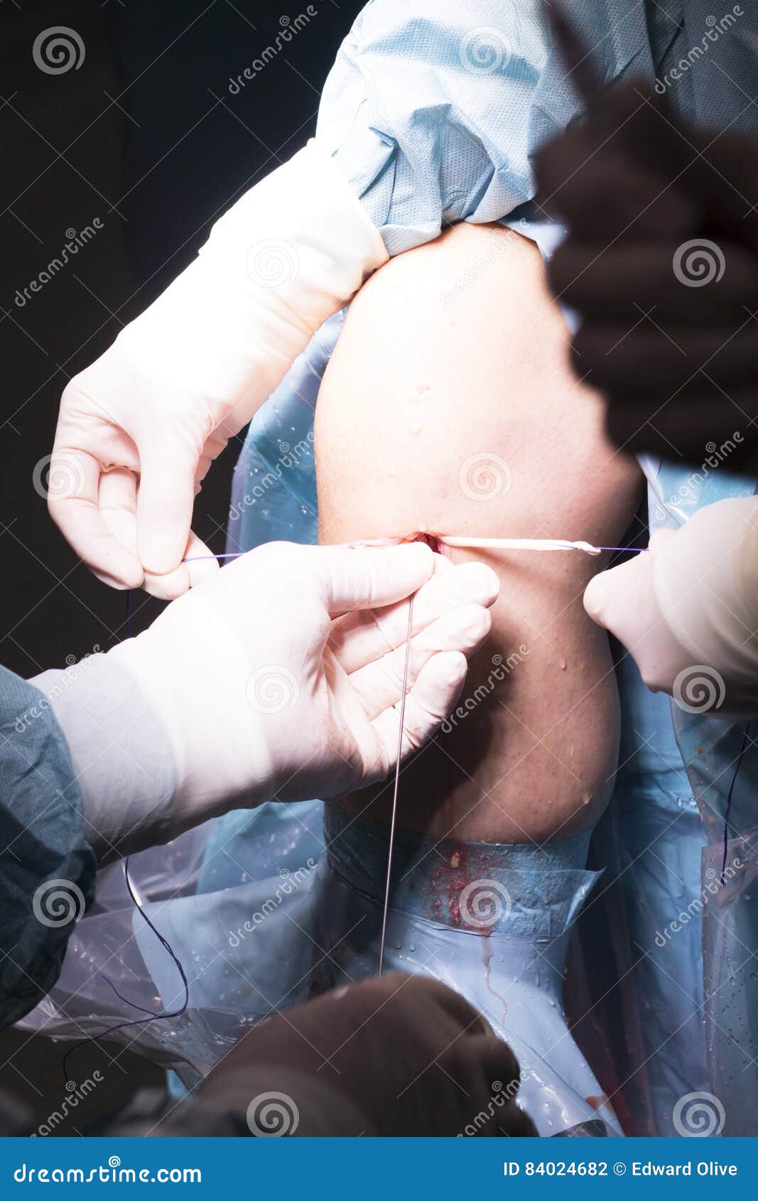 Knieoperation Der Chirurgischen Operation Stockfoto Bild von betrieb