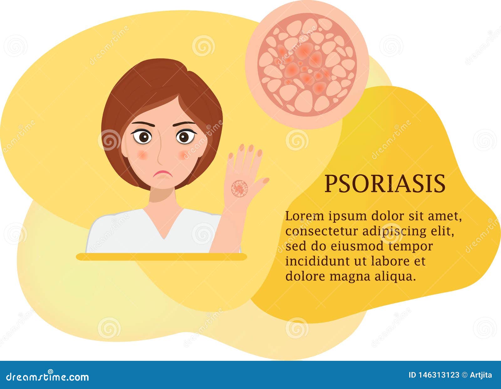 Konzept Von Psoriasis Plakat Stock Abbildung Illustration Von Gesichtsbehandlung Nett 146313123