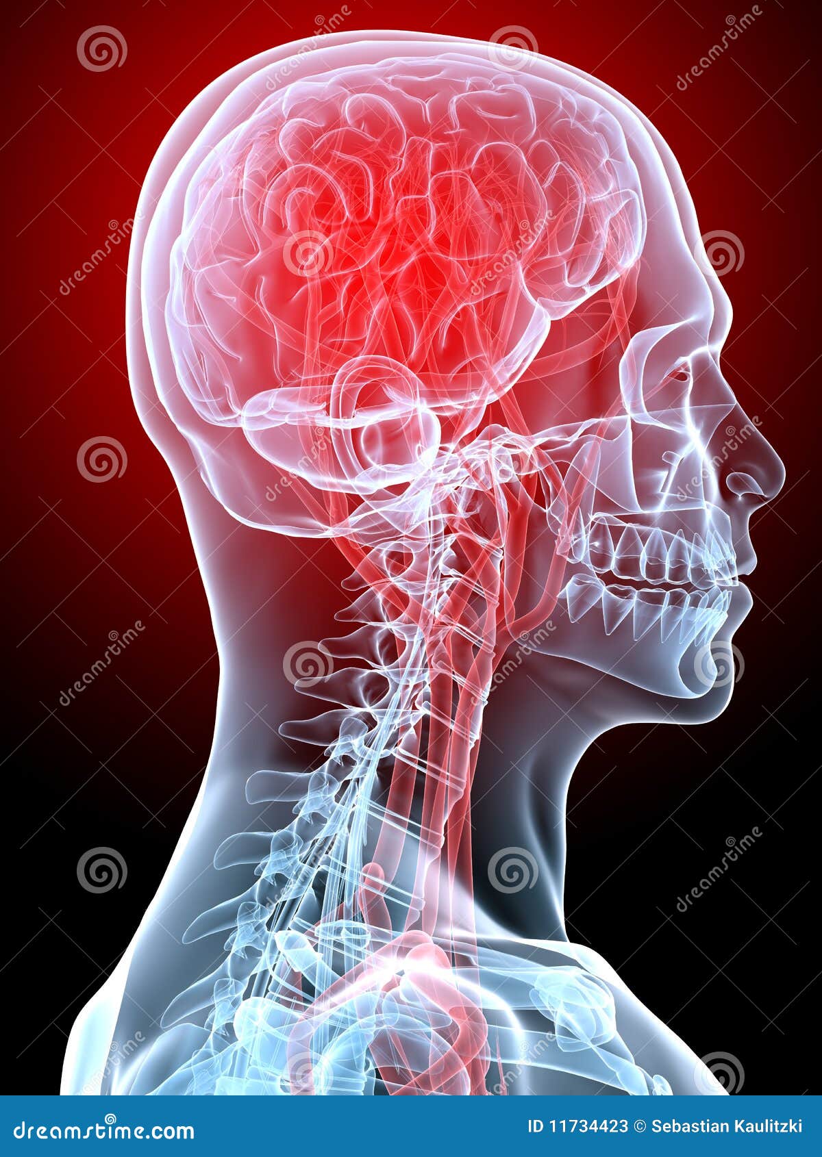 Kopfschmerzen/Migräne. 3d übertrug Röntgenstrahlabbildung des menschlichen Kopfes mit markiertem Gehirn