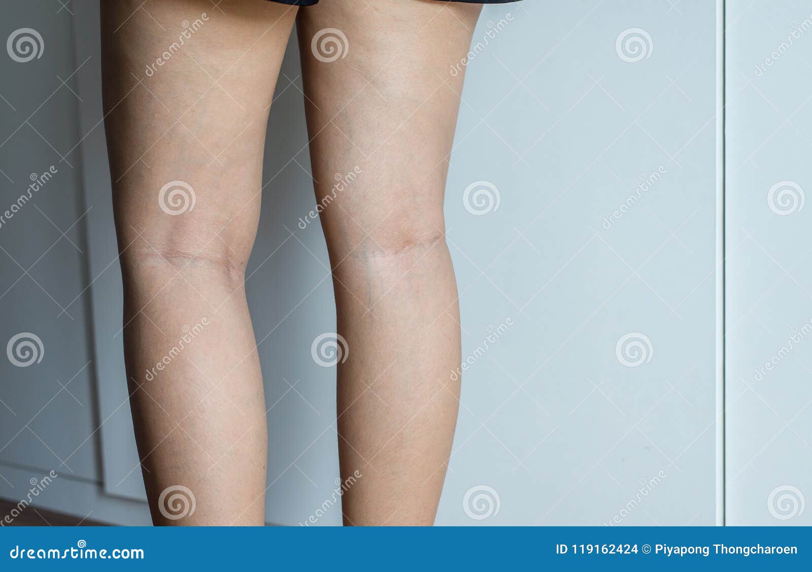 Krampfadern Auf Dem Bein Der Frau Normale Adern Nahe Der Hautschicht Schwellen Heraus Und Blut Wird Angesammelt Um Ein Blutige Stockfoto Bild Von Bein Angesammelt