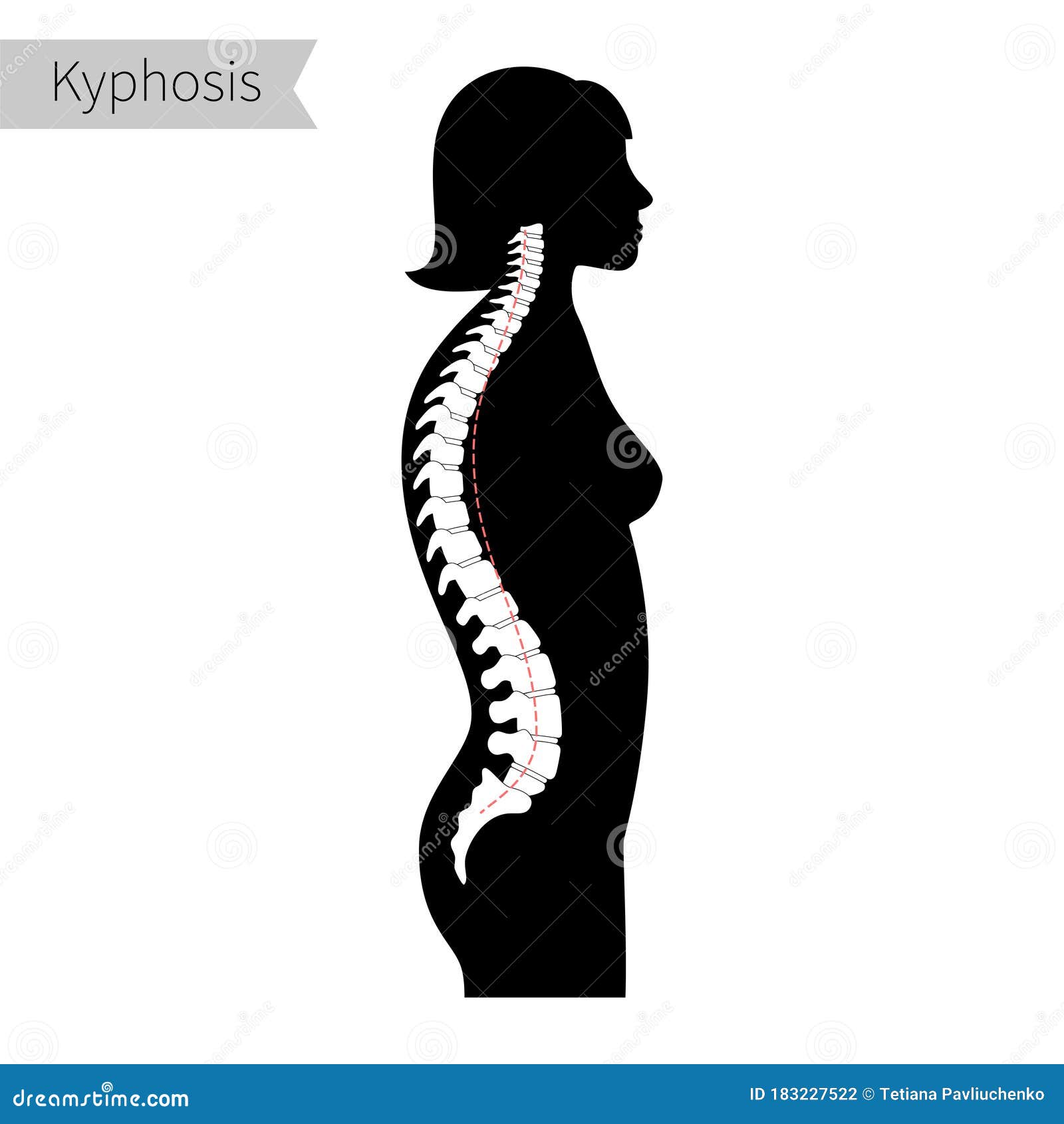 Kyphosis Flat Vector Illustration. Stock Vector - Illustration of ...