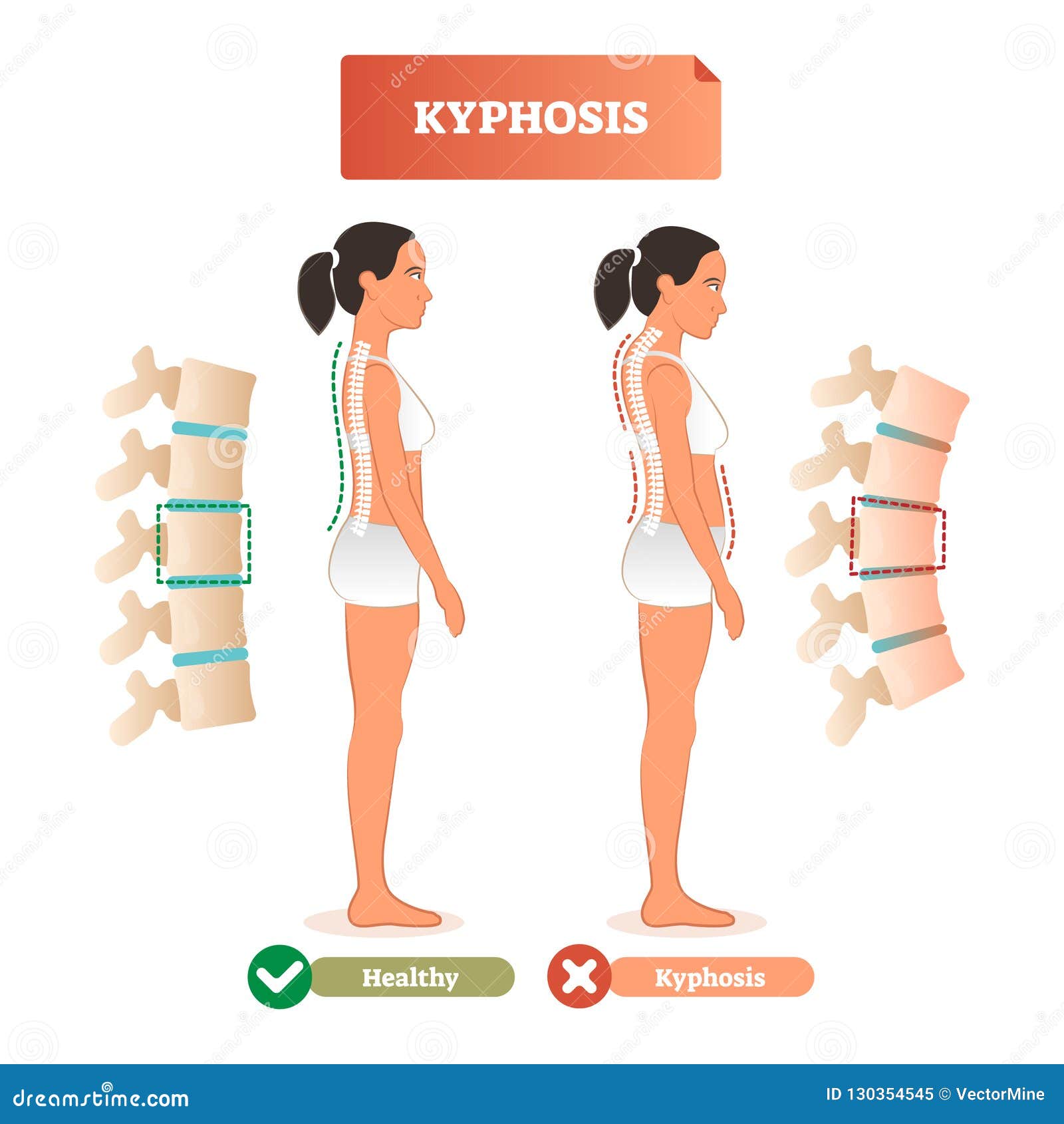 kyphosis  . back spine defect diagnosis vs healthy.