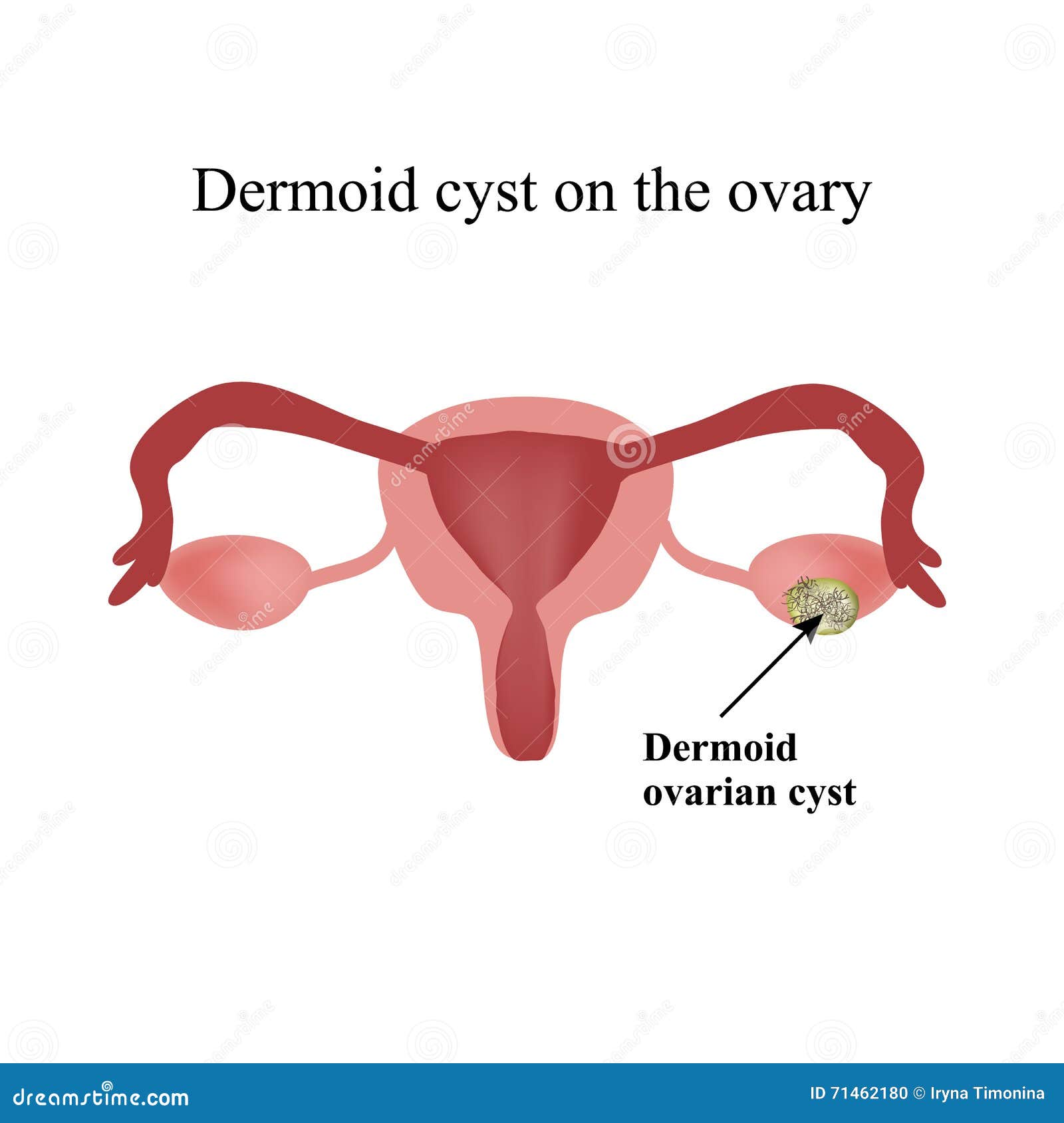 Kyste Dermoide Sur L Ovaire Illustration De Vecteur Illustration Du Menstruel Humain