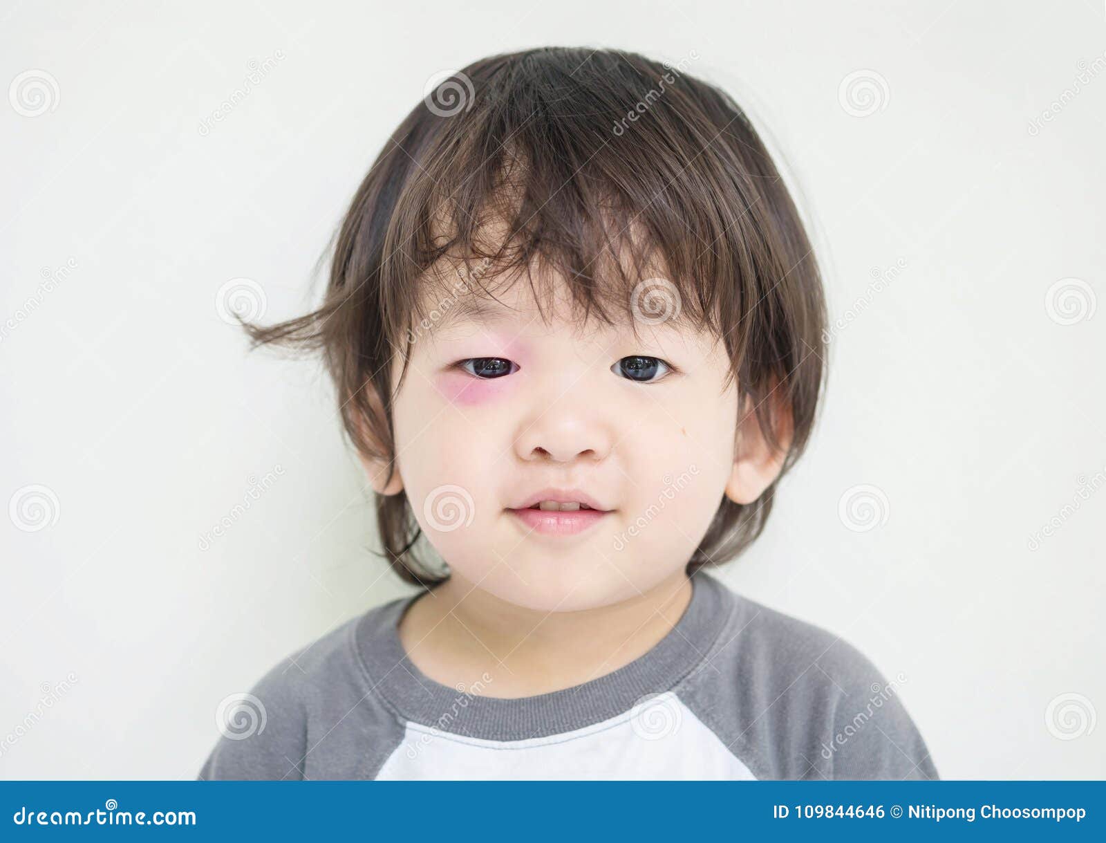 L Oeil Gonfle Par Plan Rapproche De L Enfant De La Piqure D Insectes Avec La Contusion Rouge Mais Lui Peut Sourire Photo Stock Image Du Canette Bubonique L Oeil Gonfle Par Plan Rapproche De L Enfant De La Piqure D Insectes Avec La Contusion Rouge Mais Lui Peut Sourire Photo Stock Image Du Canette Bubonique