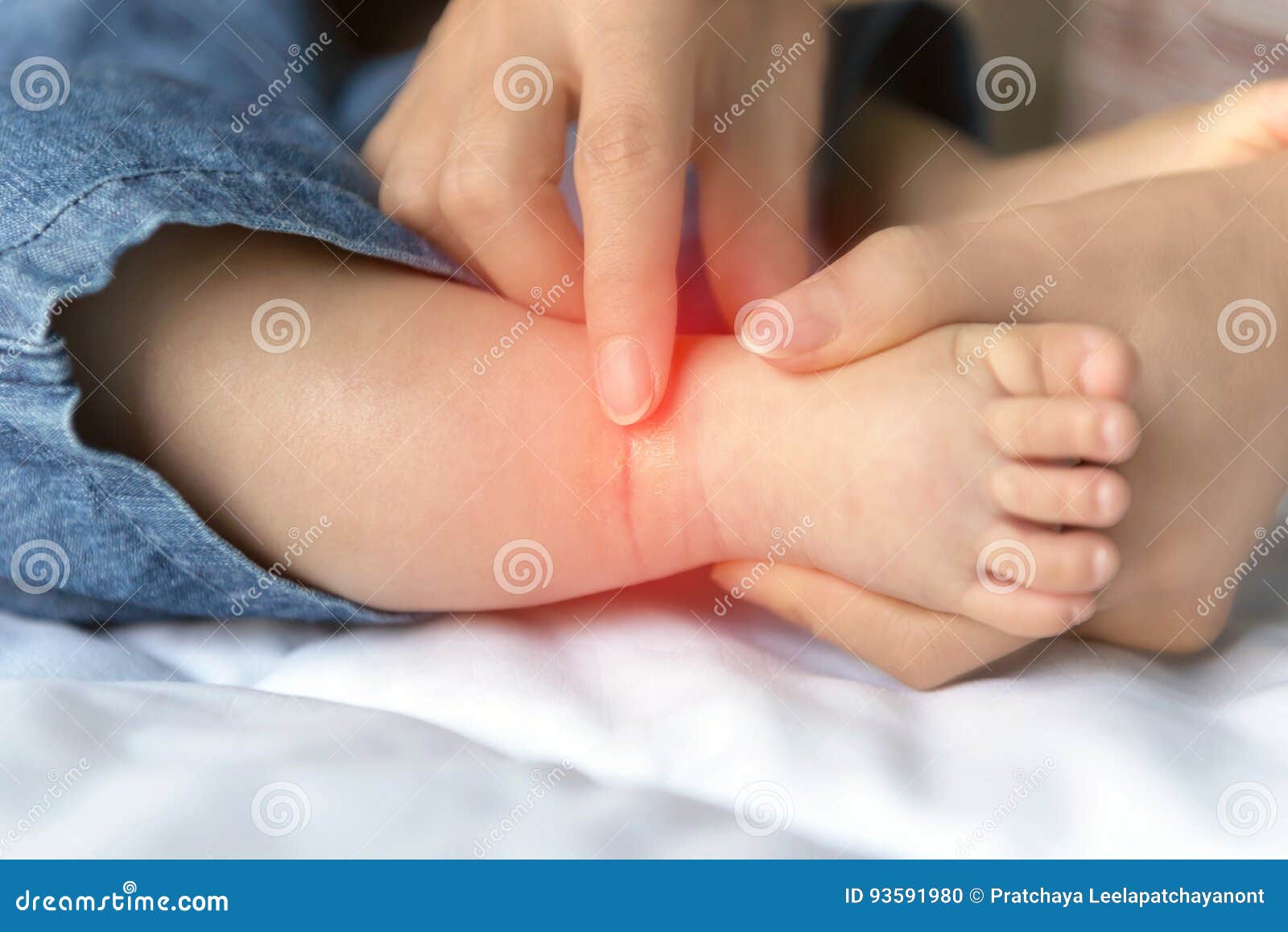 Атопический дерматит на ногах у ребенка