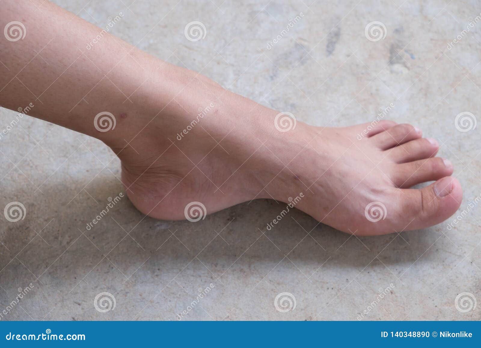 Lap Feet or Flat Foot stock image. Image of healthy - 140348631