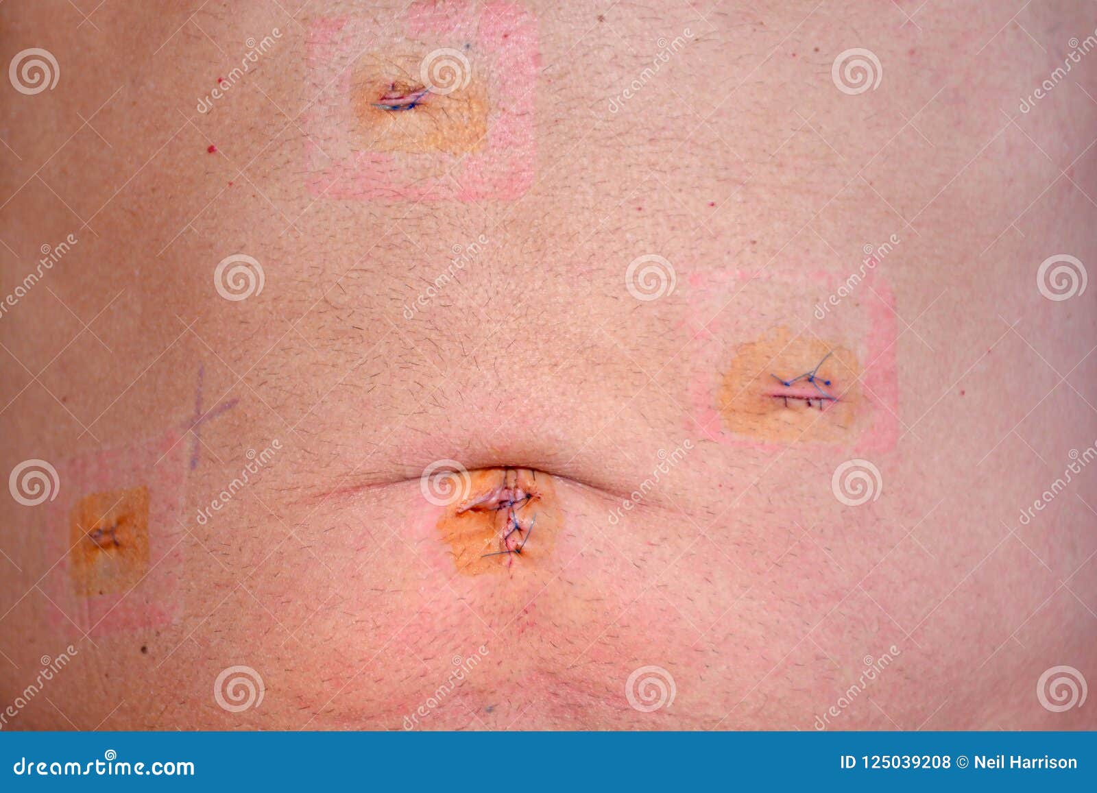 laparoscopic cholocystectomy scars