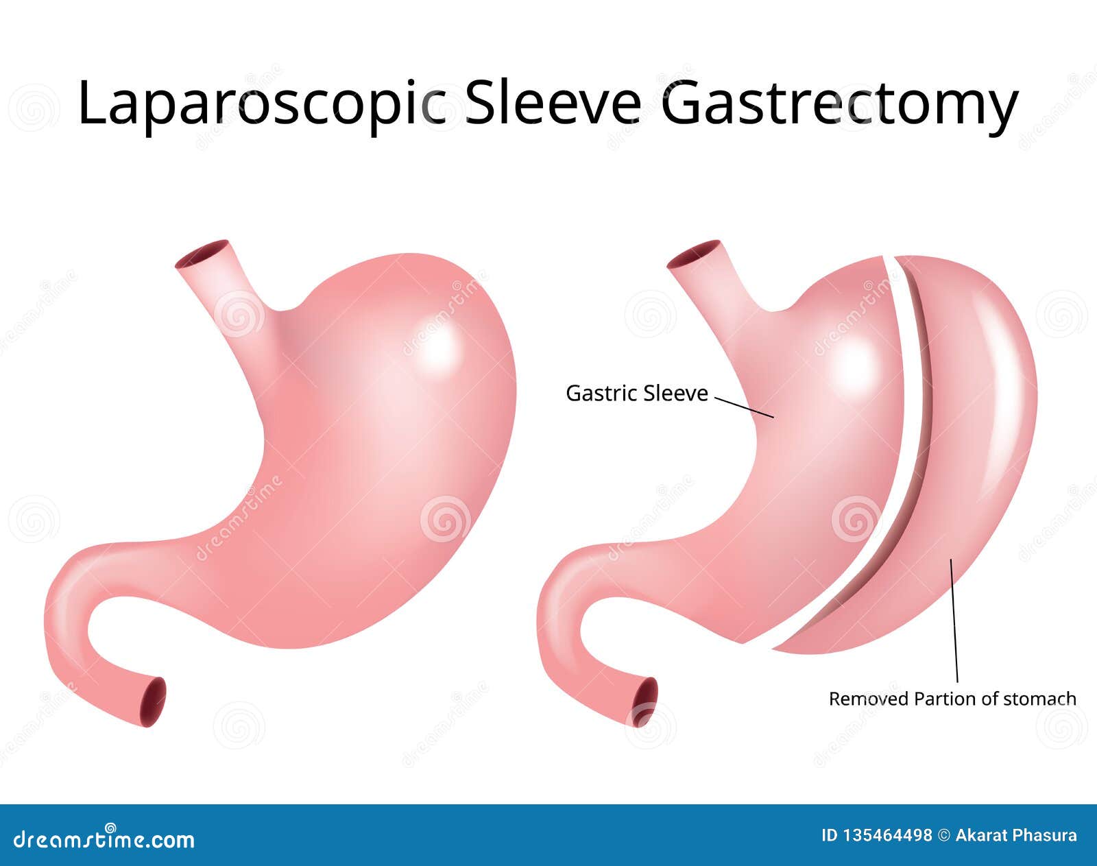 laparoscopic sleeve gastrectomy / weight loss surgery - 