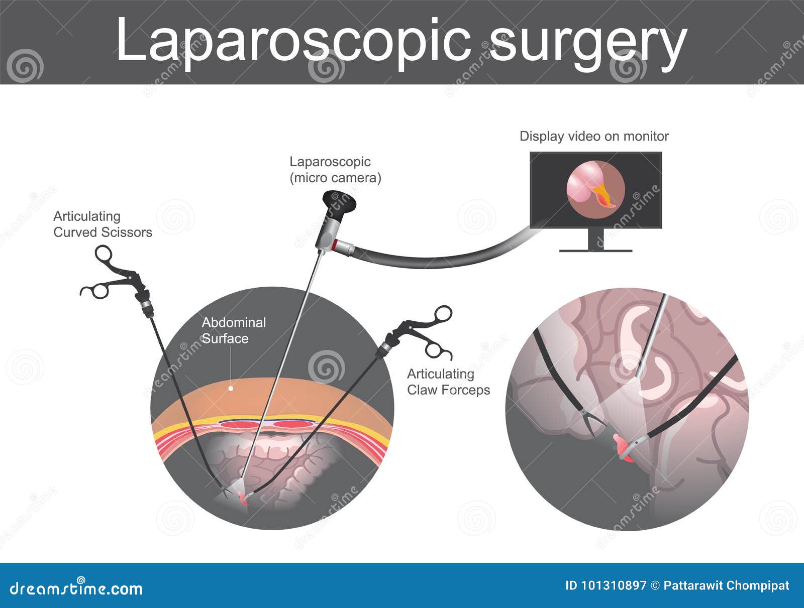 laparoscopic surgery. technical surgery which operations are per