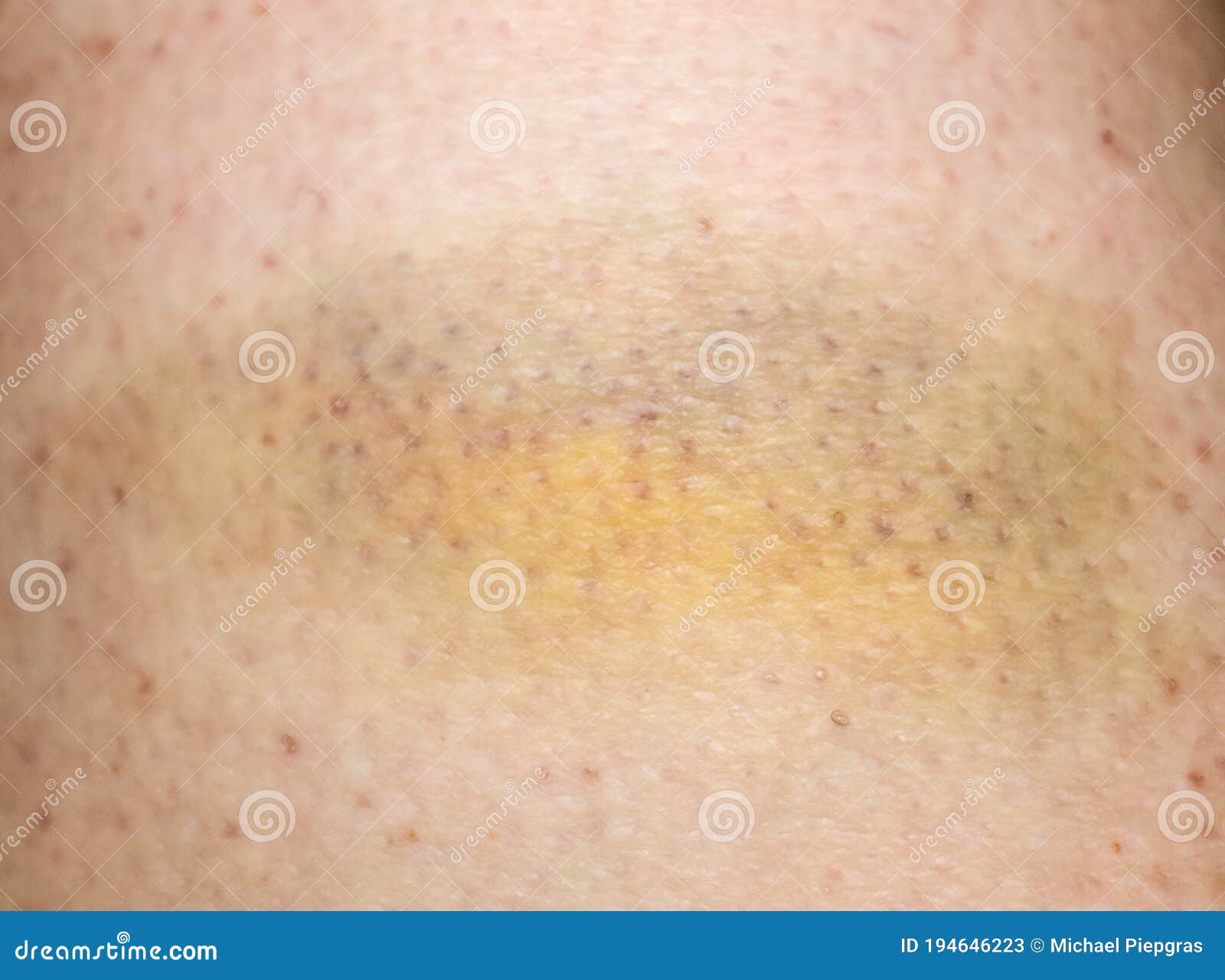 Large Bruise Hematoma On The Humans Leg On The Skin In Different Colors