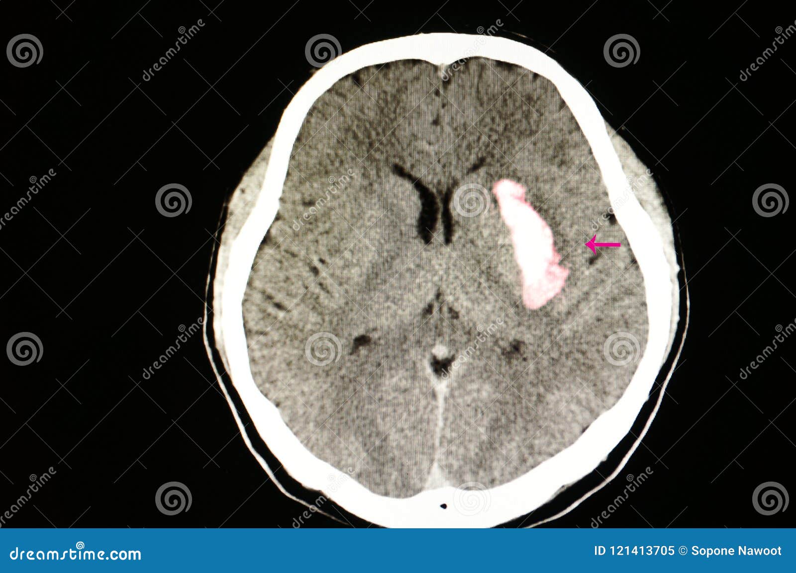 large intracerebral hematoma