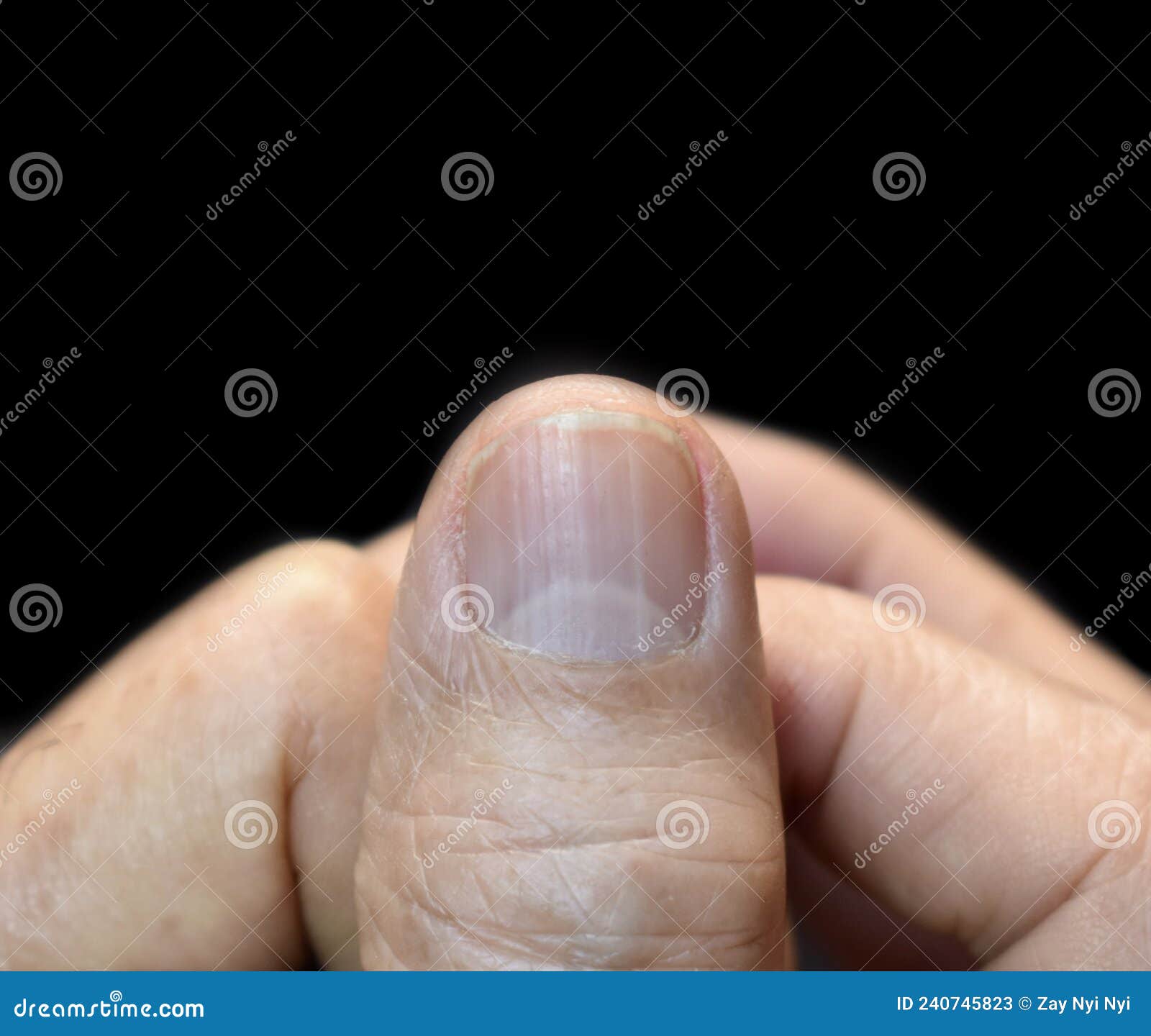 D e r m o s c opy of the nail plate showing l o n g i t u d i n a l... |  Download Scientific Diagram