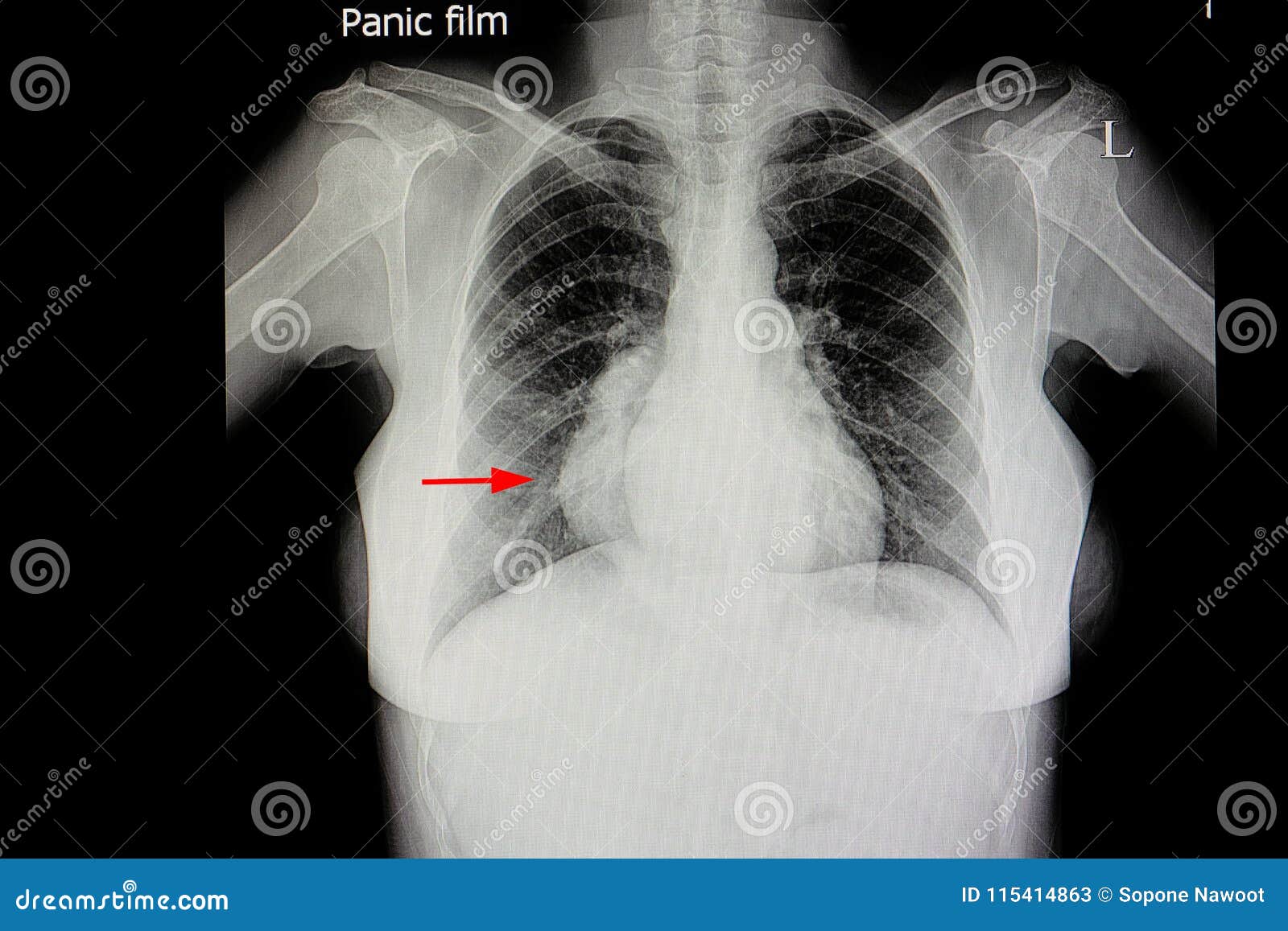 Large Mediastinal Lung Mass Stock Image - Image of medical, medicine ...