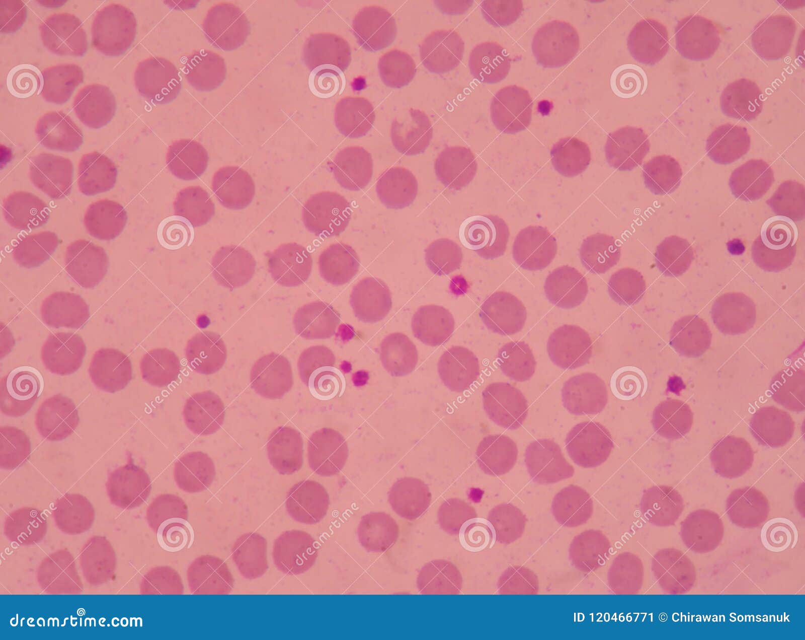 large platelets on blood smear.