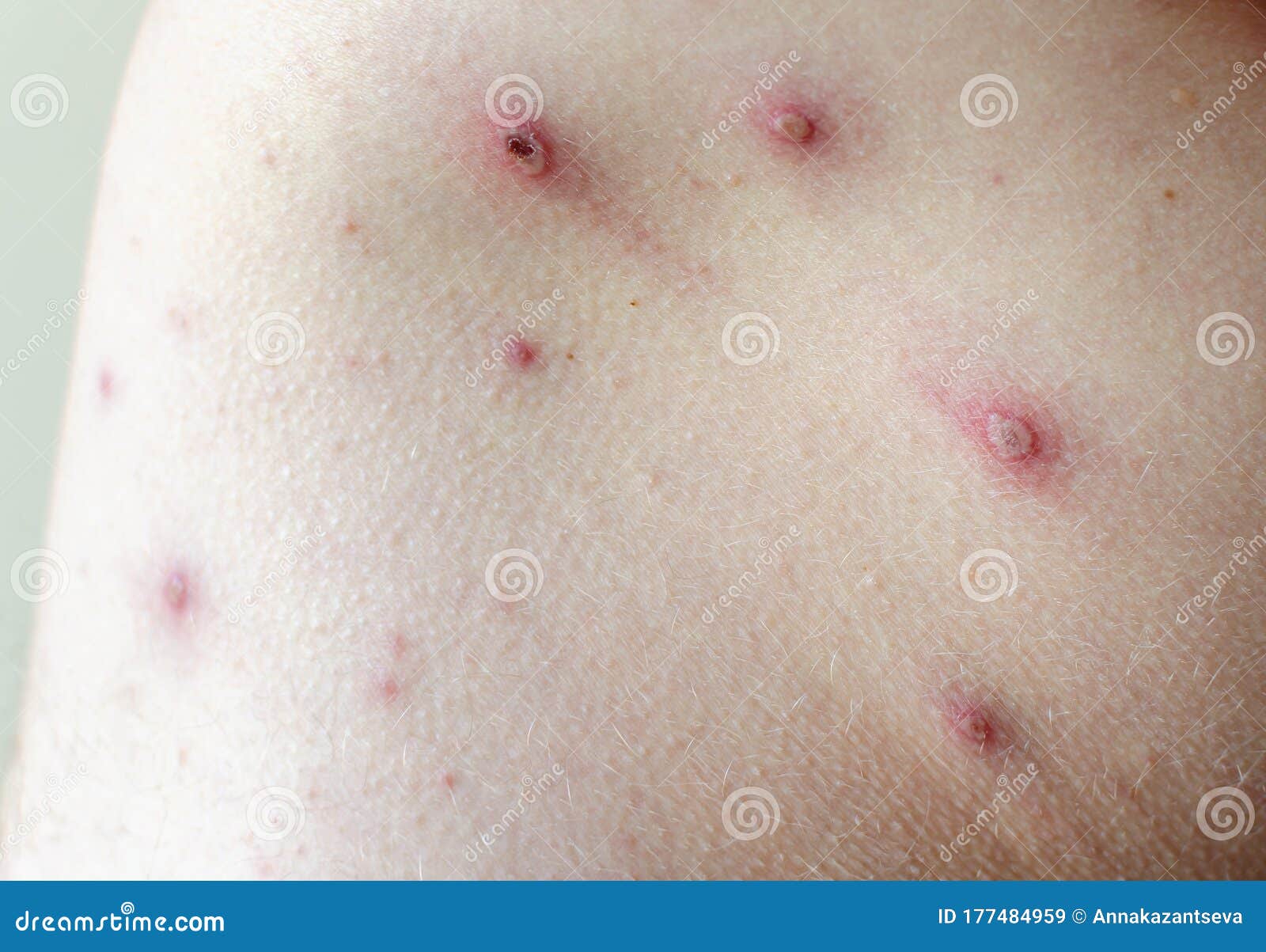 Large Spots And Pimples Acne On The Body - Adult Body With Chickenpox