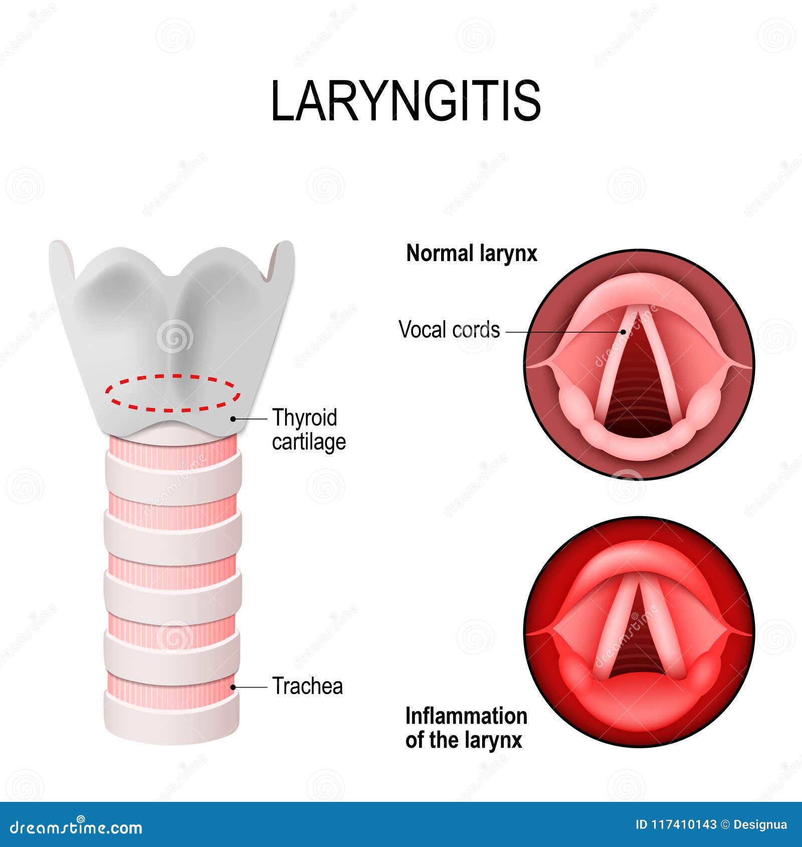 Laryngitis. Normal and Inflamed Larynx Stock Vector - Illustration of cartilage, health: 117410143 Laryngitis. Normal and Inflamed Larynx Stock Vector - Illustration of cartilage, health: 117410143