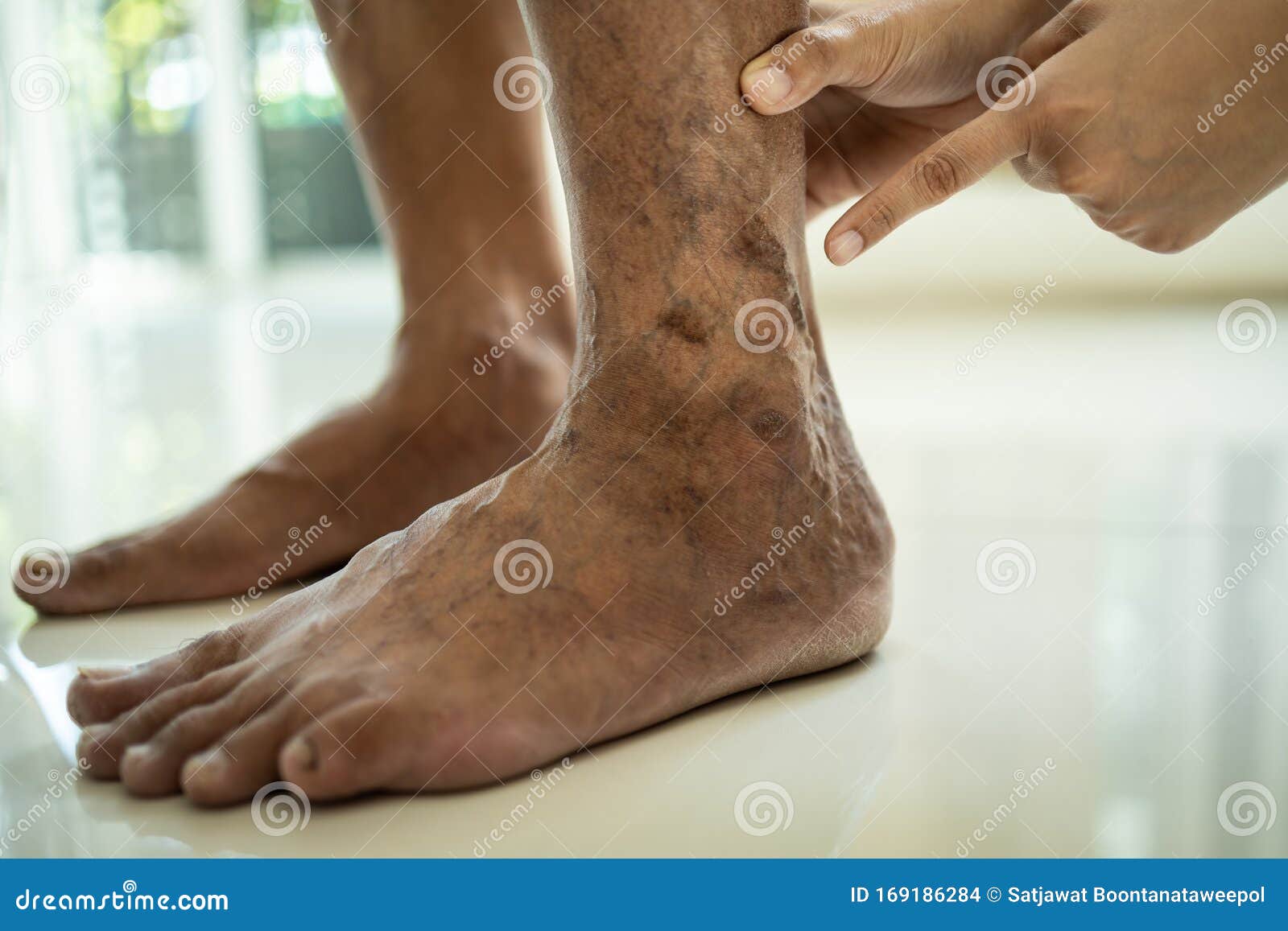 Varicozarea picioarelor - Ce poziție a picioarelor să ia cu varicoza
