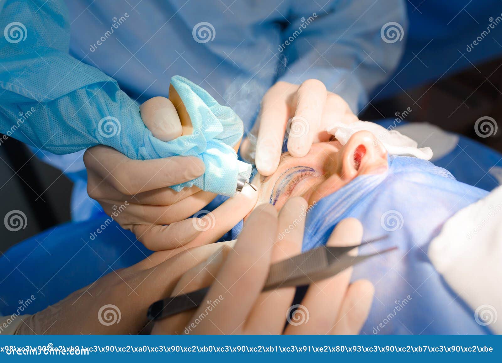 Laser Blepharoplasty, Plastic Surgery Operation for Correcting Defects