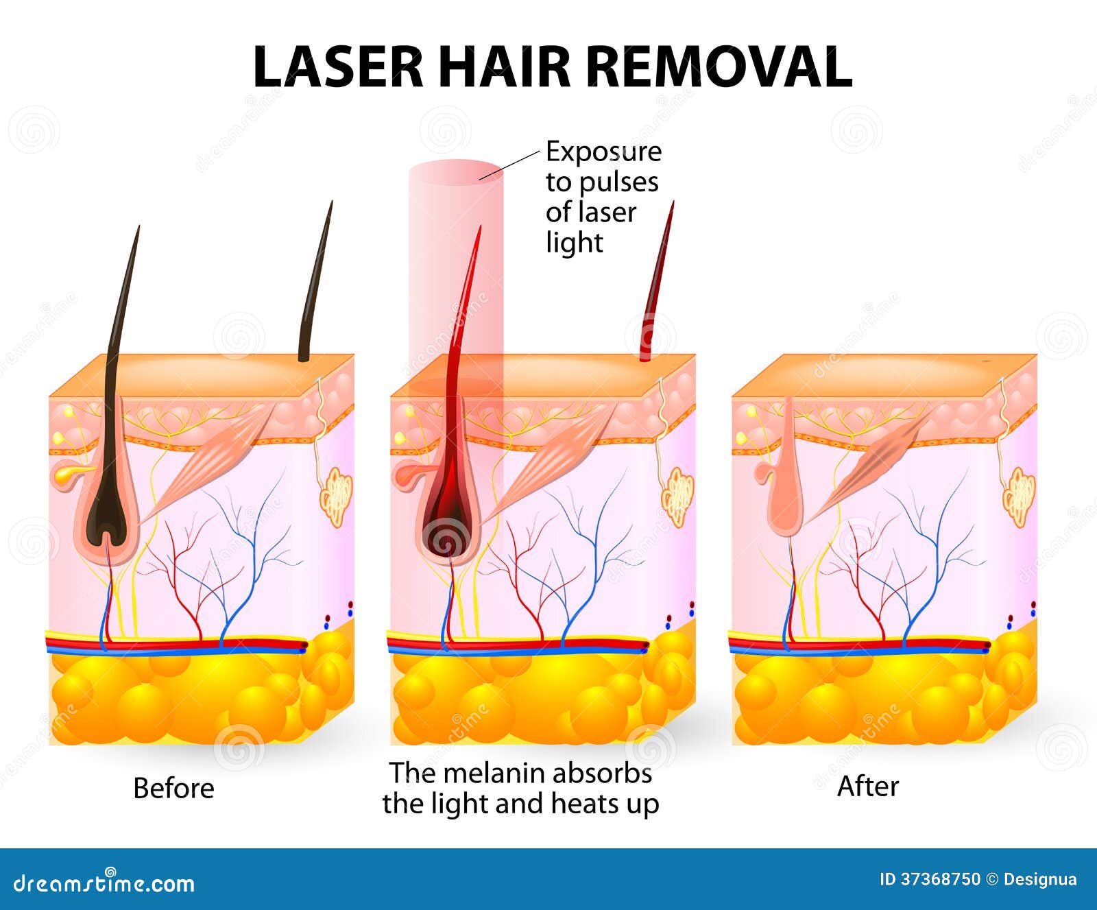 Laser Hair Removal Vector Diagram Stock Vector Illustration Of