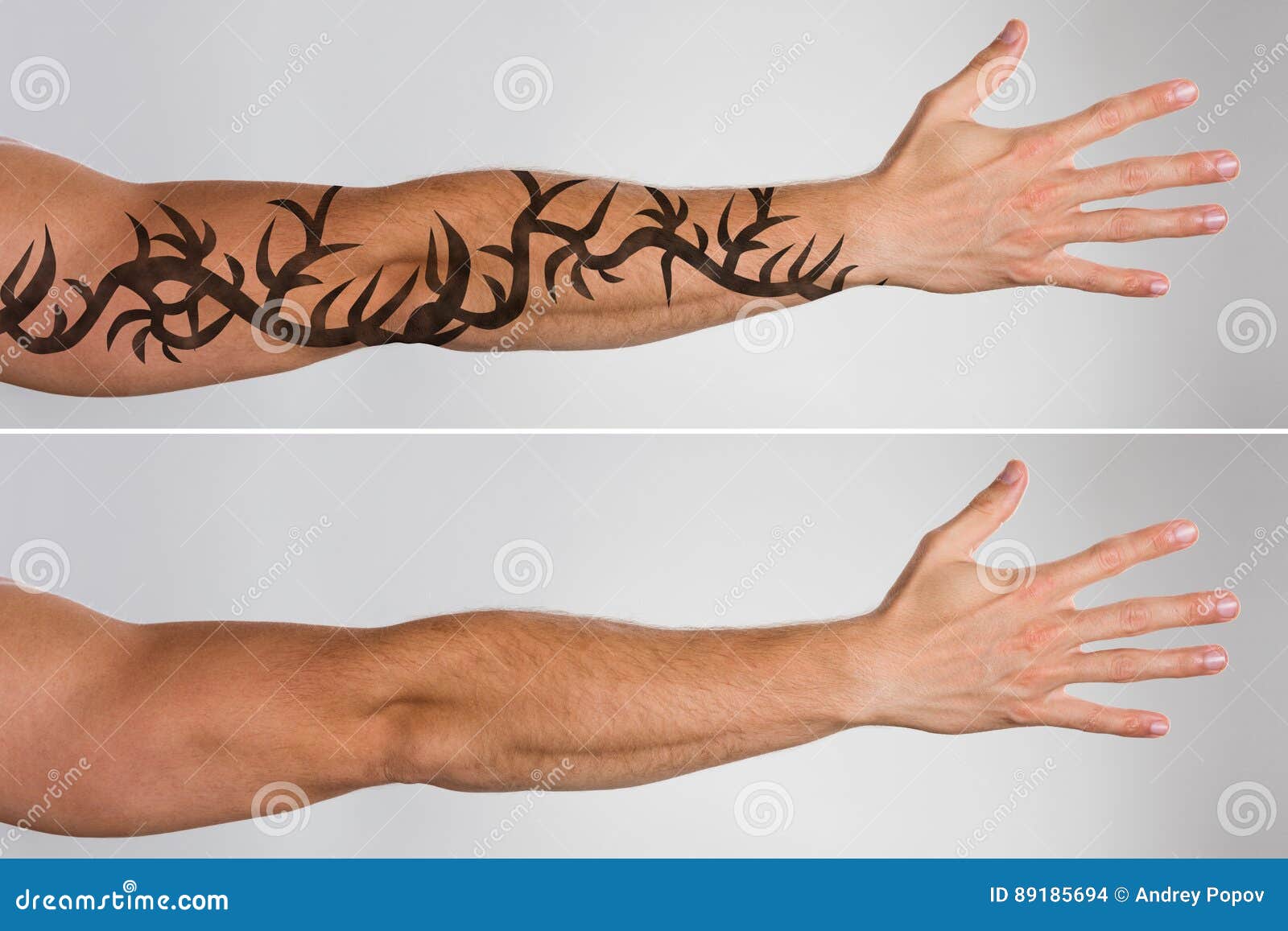 Picosure Laser Tattoo Removal Before and After Best Results