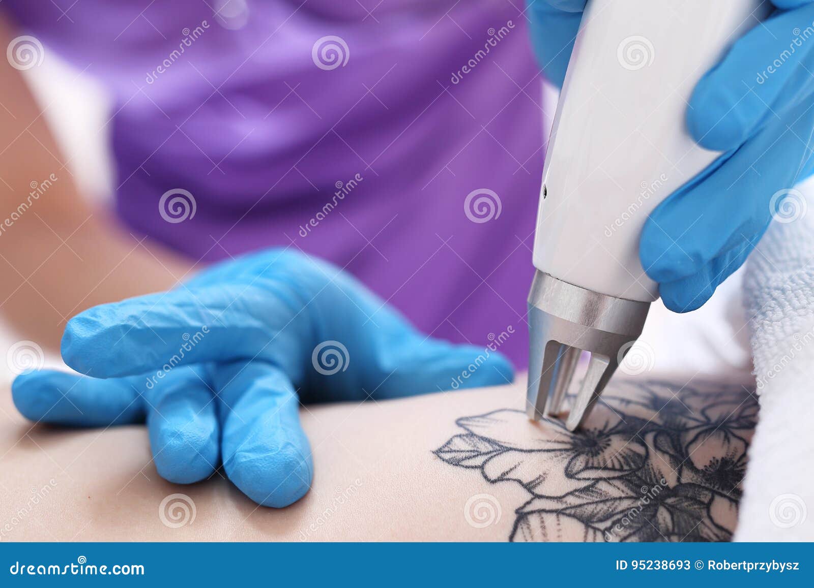 laser tattoo removal in cosmetic surgery.