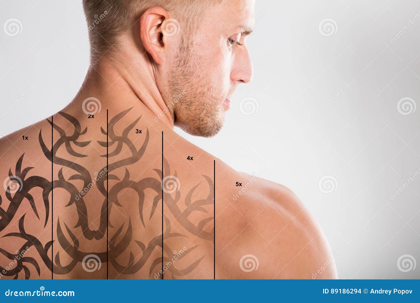 laser tattoo removal on man`s back