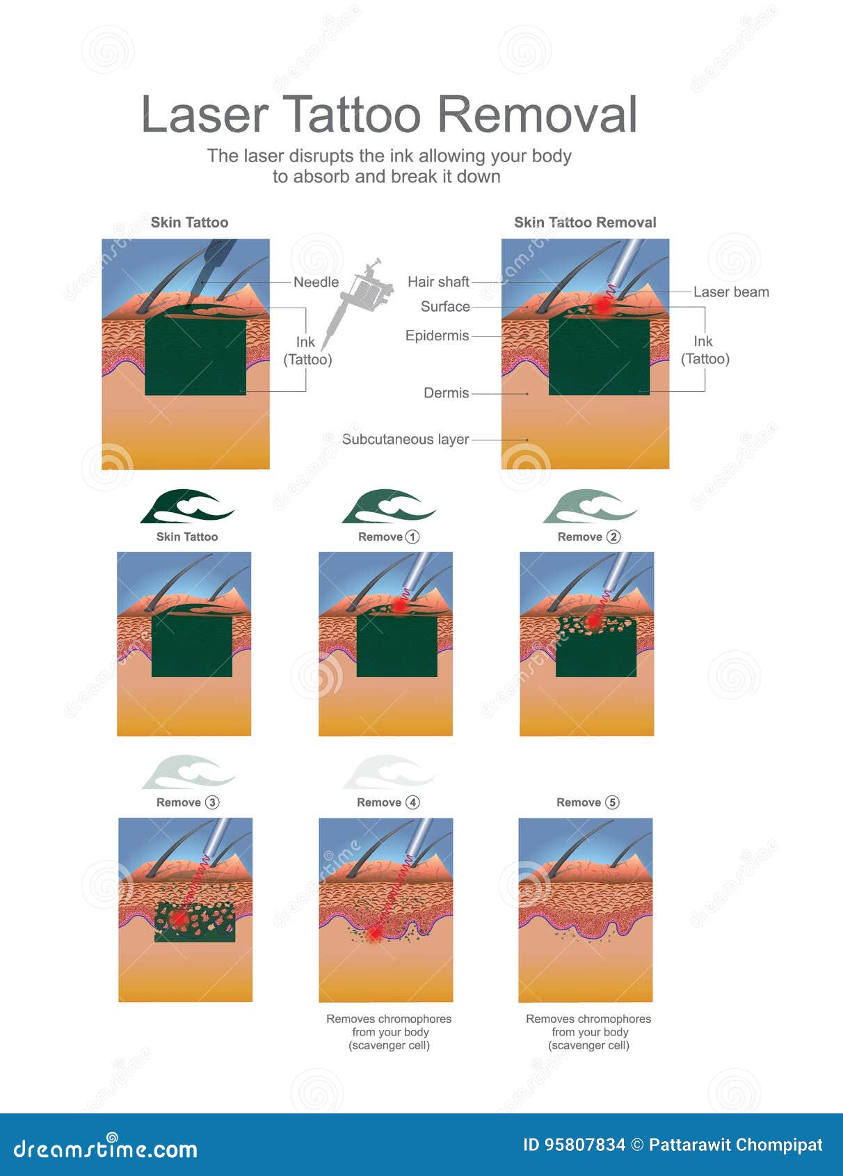 Laser Tattoo Removal stock illustration. Illustration of acid 95807834