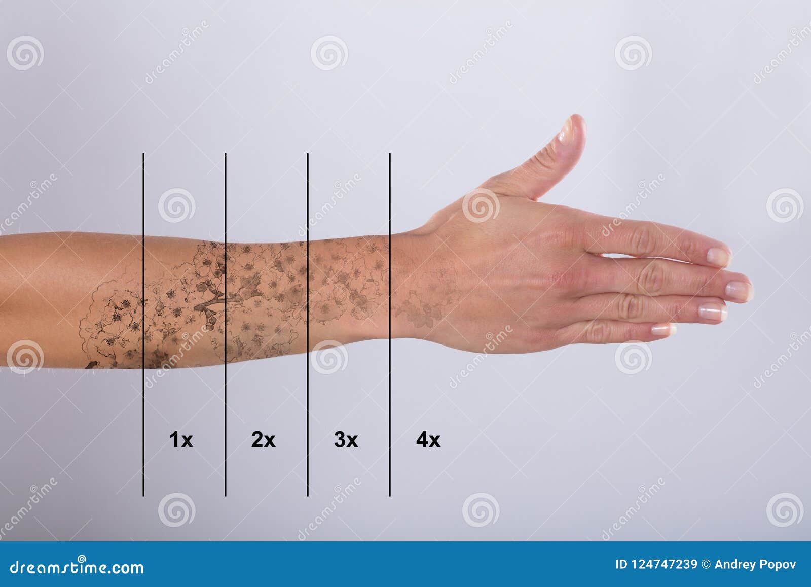 laser tattoo removal on woman`s hand
