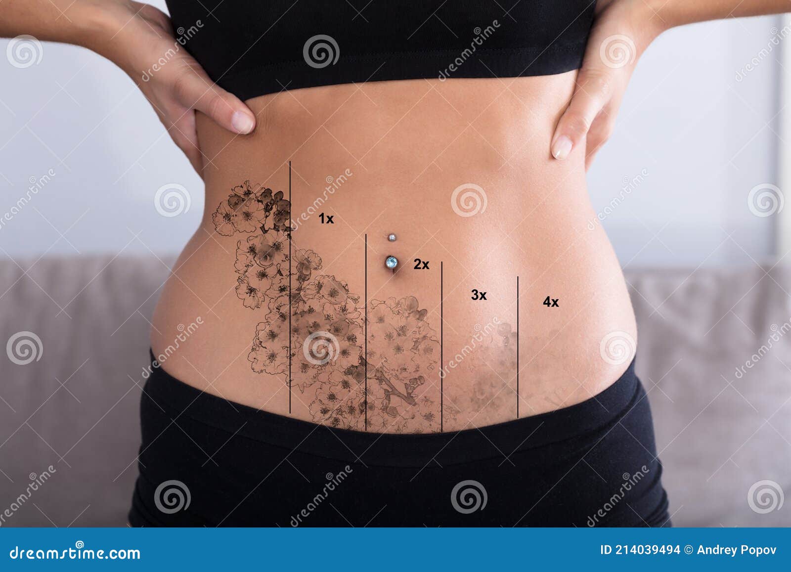 Stomach Tattoo Removal Results  Case Study  Removery