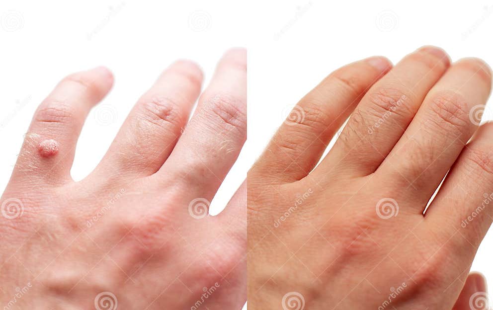 Laser Treatment for Wart Removal before and after. Stock Image Image