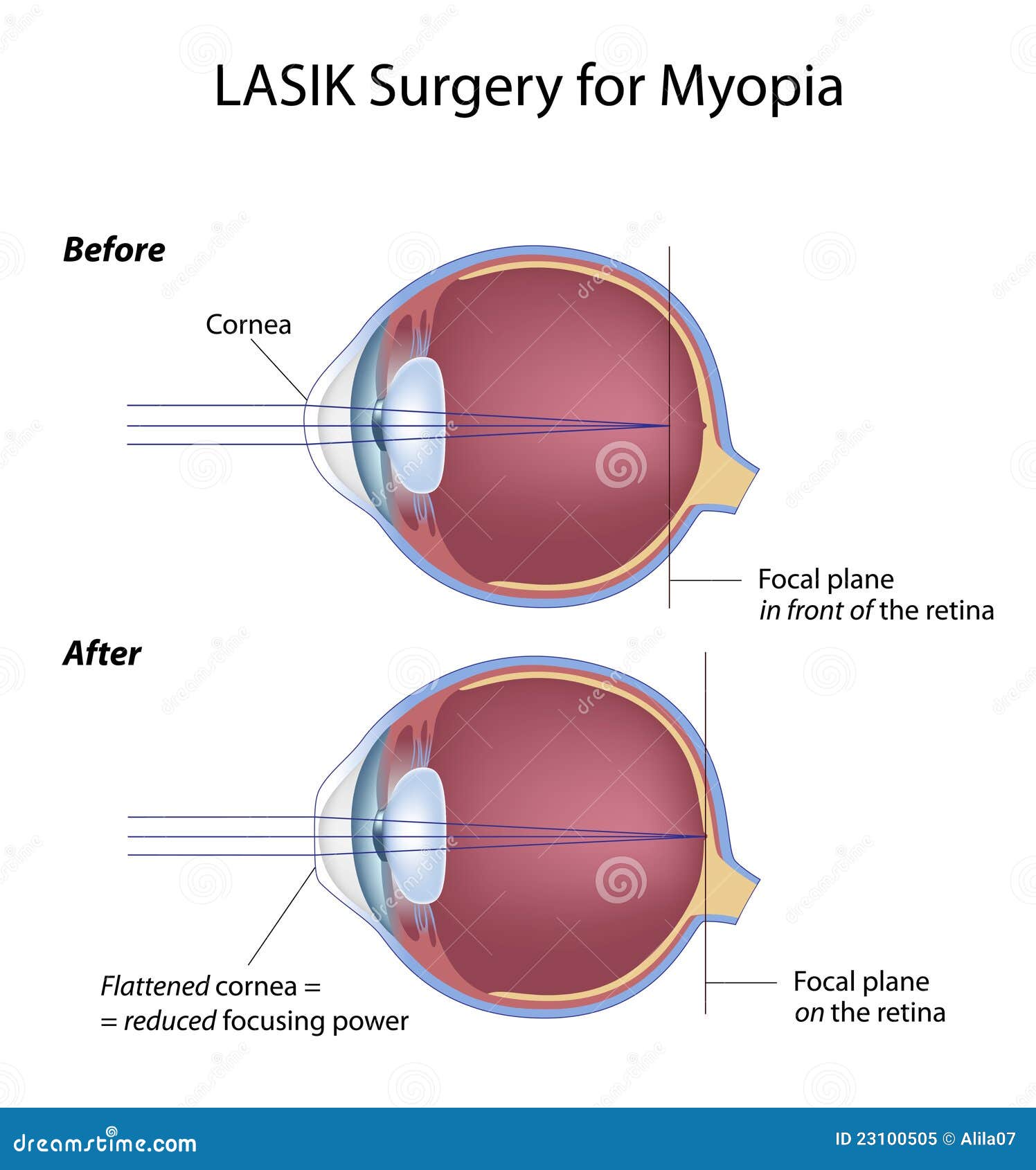 myopia lézer