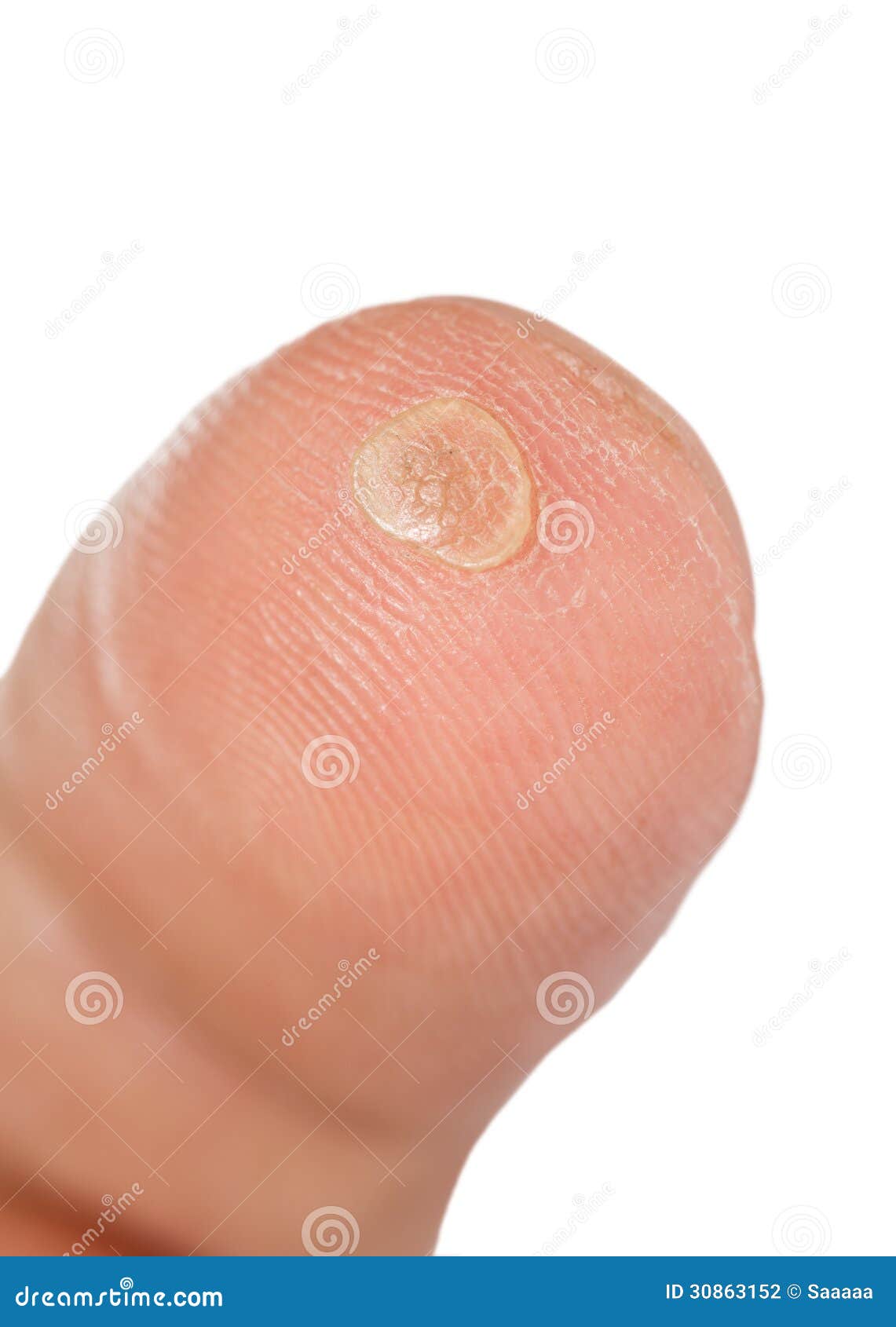 Last stage of verruca stock photo. Image of view, stage 30863152