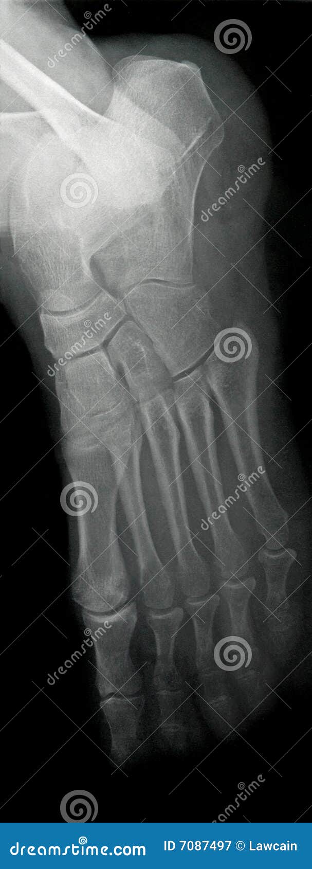 Lateral Foot Xray stock image. Image of fracture, ankle 7087497