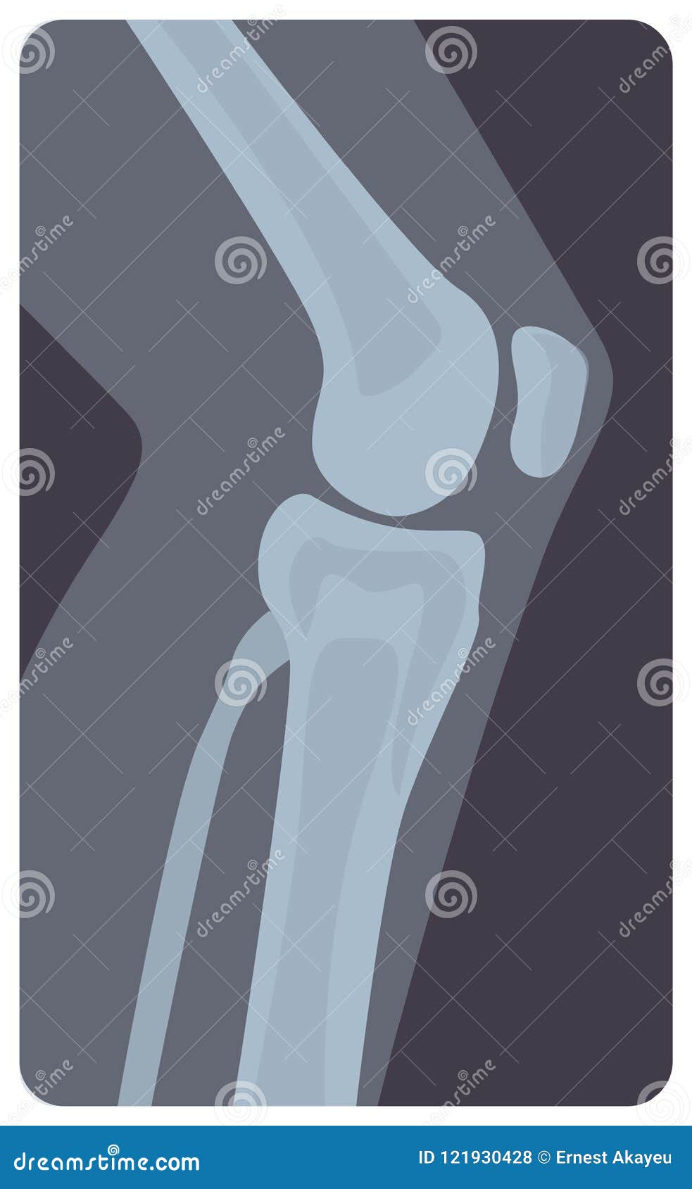 lateral radiograph of human knee joint. monochrome x-ray picture or radiographic monitor image of leg part, side view