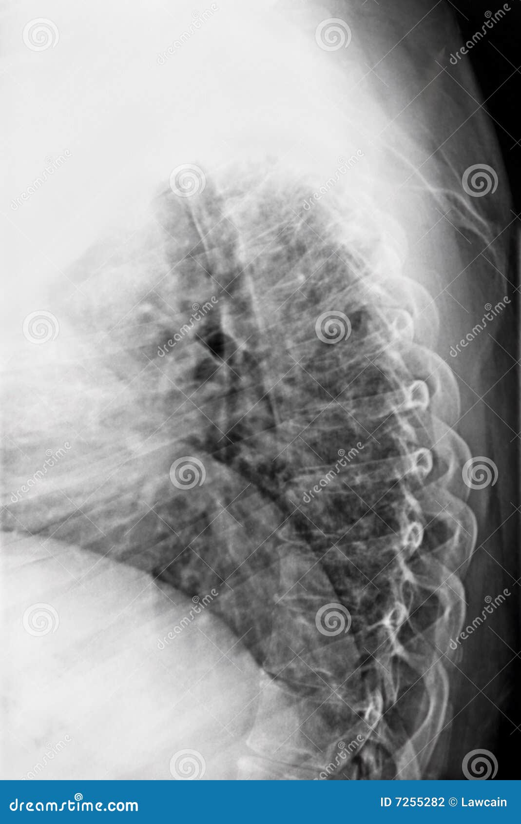 Lateral Tspine Xray stock photo. Image of radiography 7255282