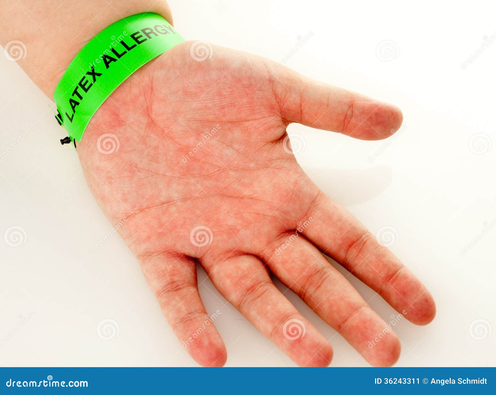 Patient Wristband  Specialty Latex Allergy  A1 Medical Integration